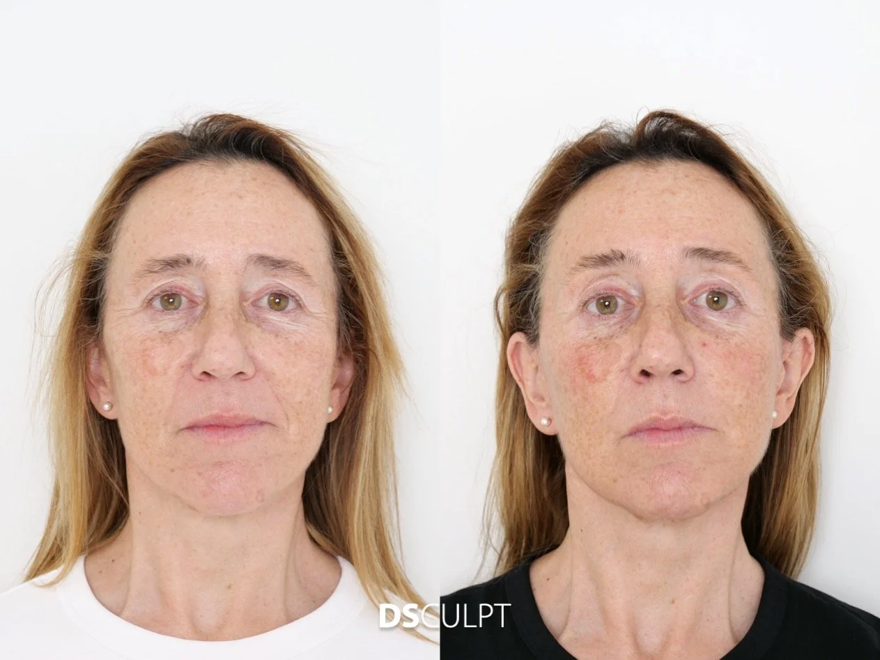 Resultado del tratamiento Smart DNA en Barcelona mostrando mejora de la textura y luminosidad de la piel facial