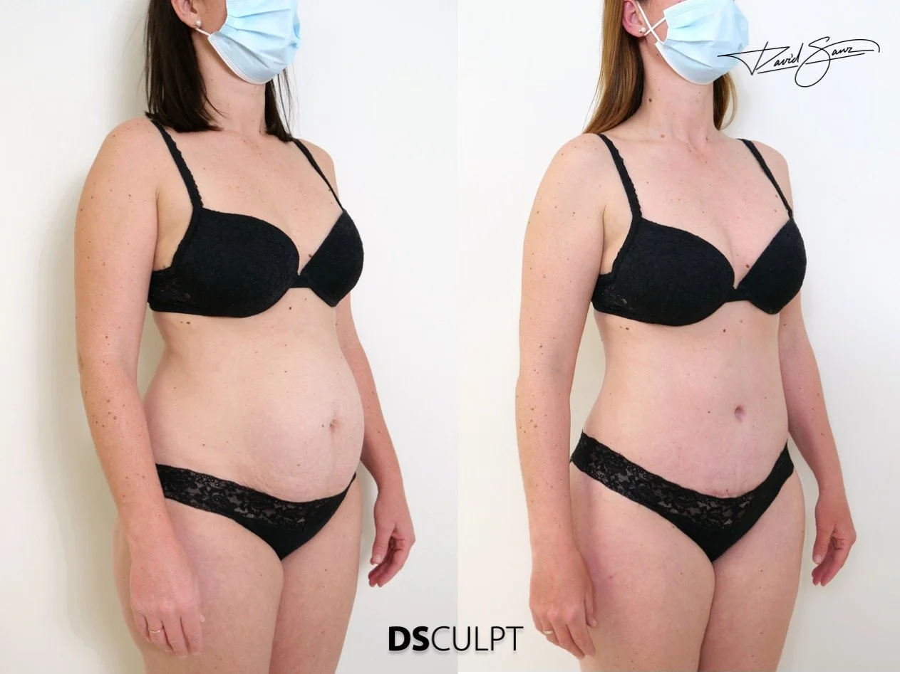 diagnóstico de diástasis de rectos mediante exploración clínica abdominal