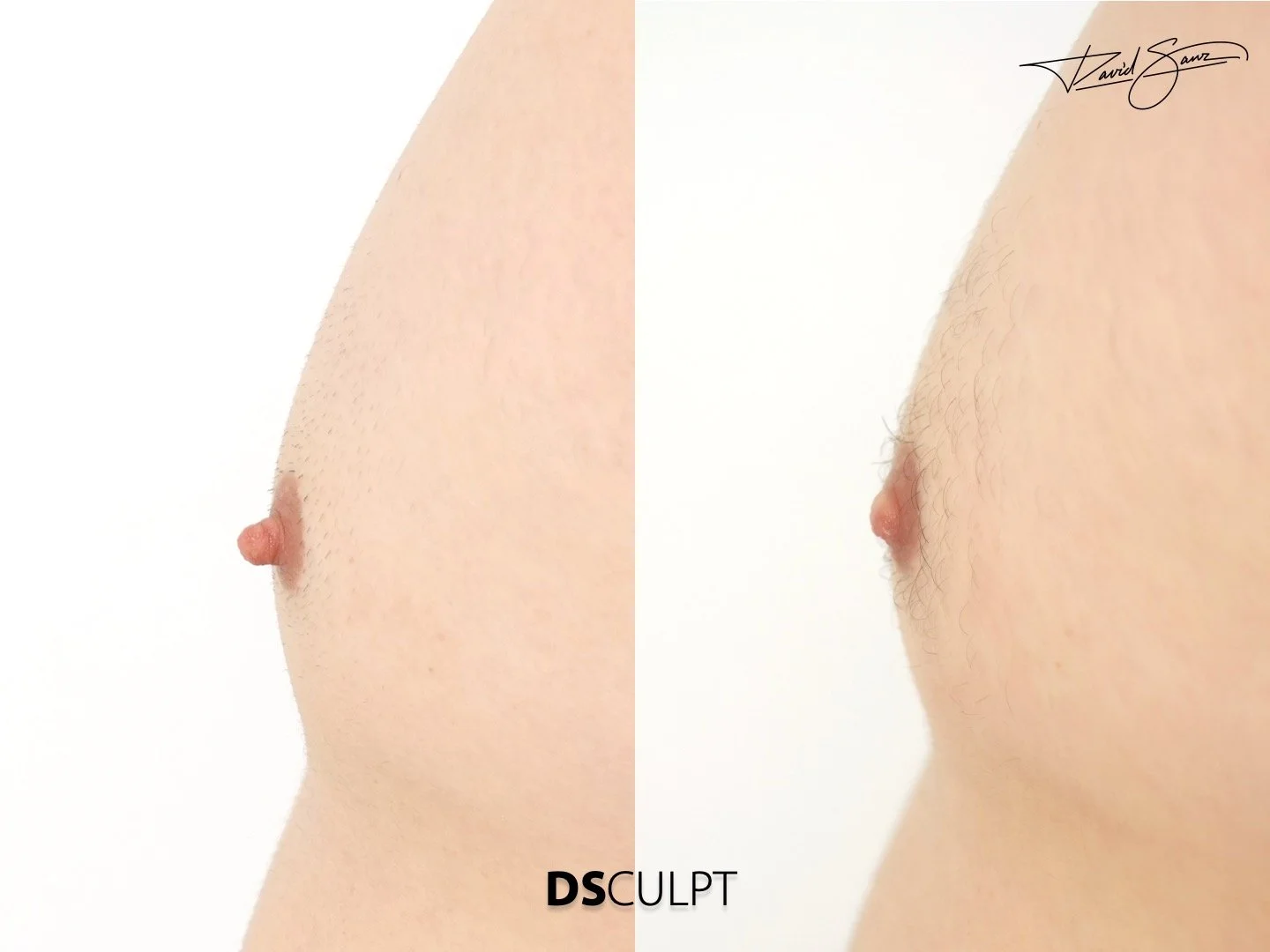 Antes y después de reducción de pezón en hombre en Barcelona. Corrección de pezón prominente con resultado natural