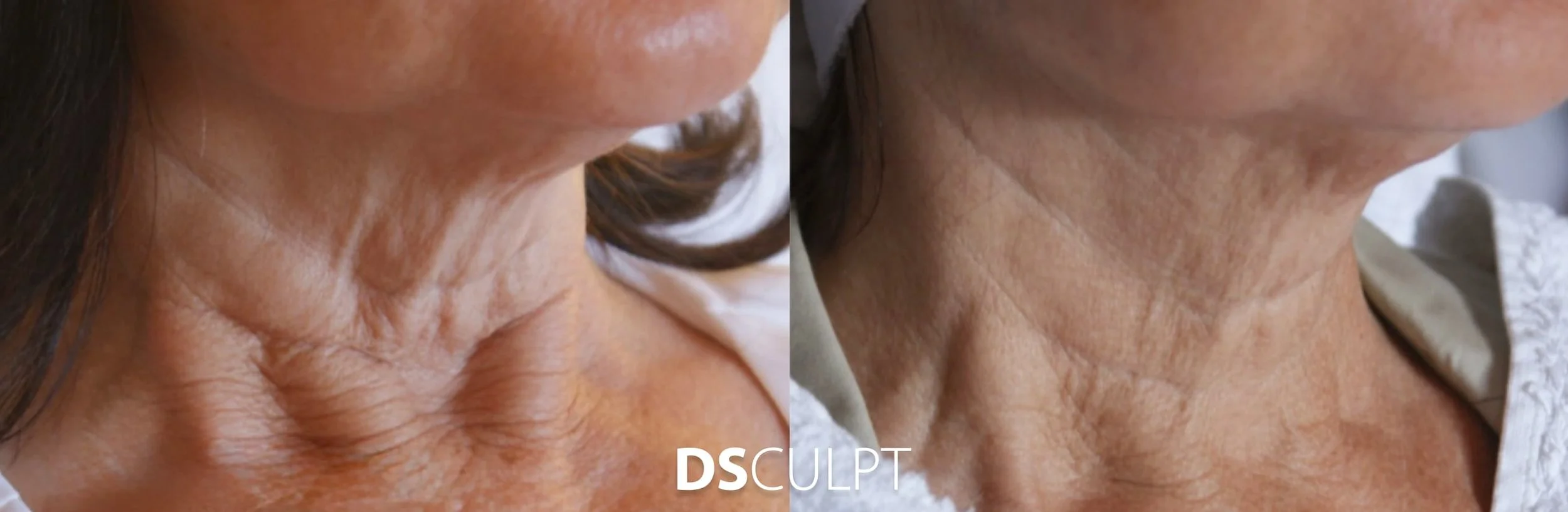 Antes y después de Morpheus en cuello y papada en Barcelona para mejorar flacidez, textura y calidad de la piel sin cirugía