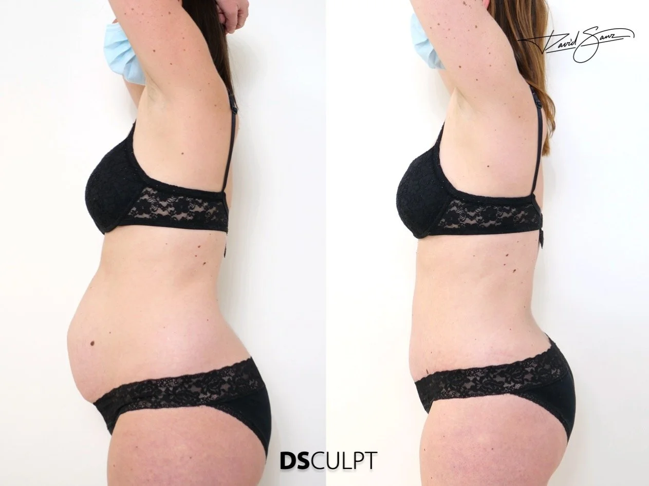 abdomen tras embarazo con diástasis de rectos y necesidad de reconstrucción