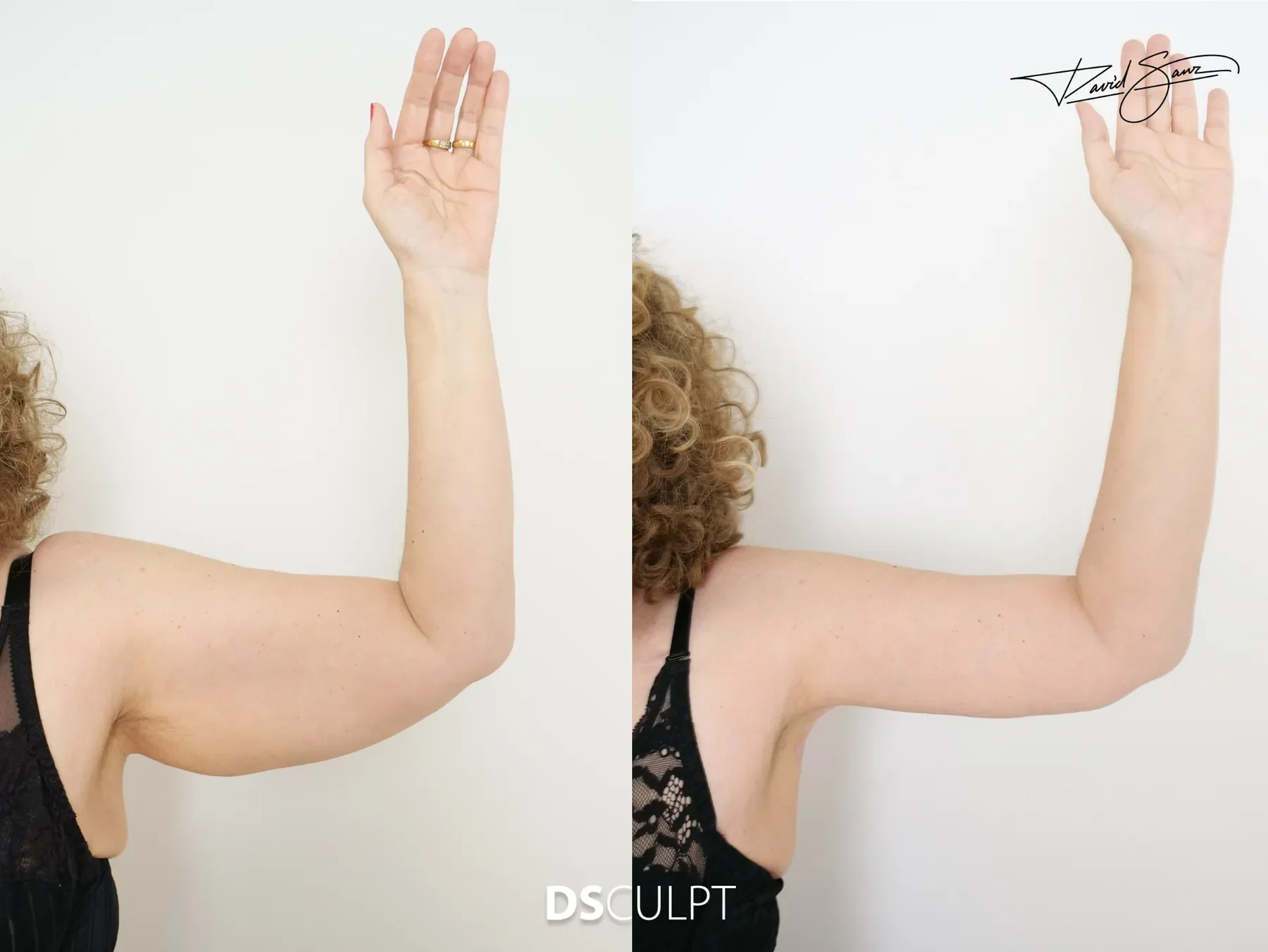 Antes y después de braquioplastia en Barcelona para tratar exceso de piel y flacidez severa de los brazos