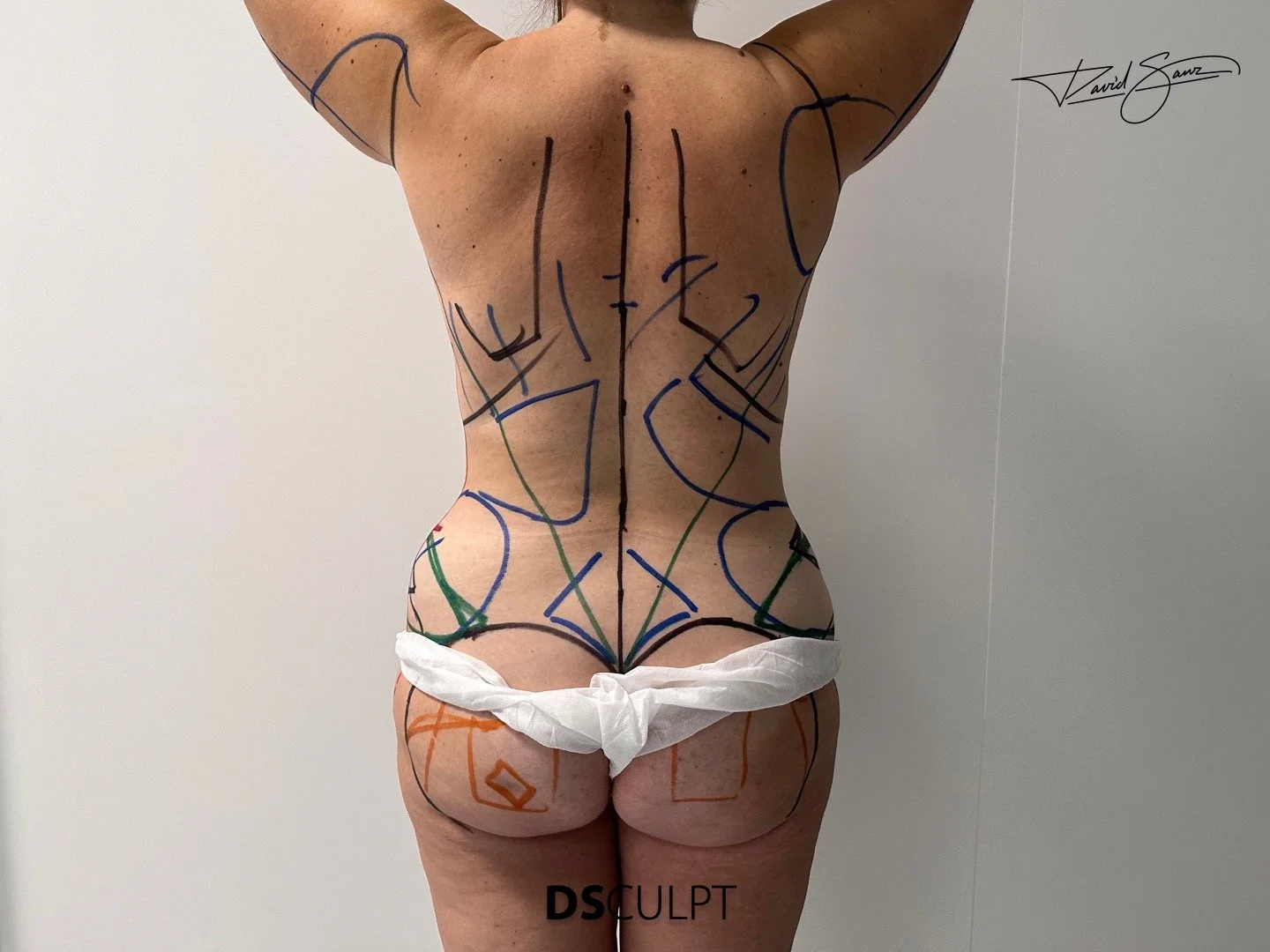 Planificación quirúrgica de abdominoplastia 360 en Barcelona con diseño del área abdominal anterior y flancos