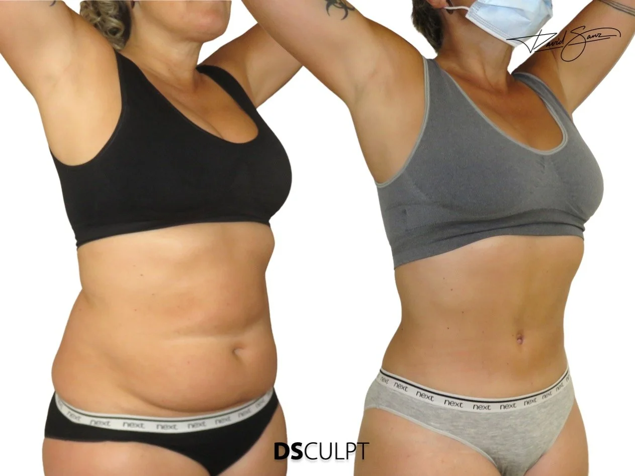 resultado de abdominoplastia con cintura definida y abdomen plano en Barcelona