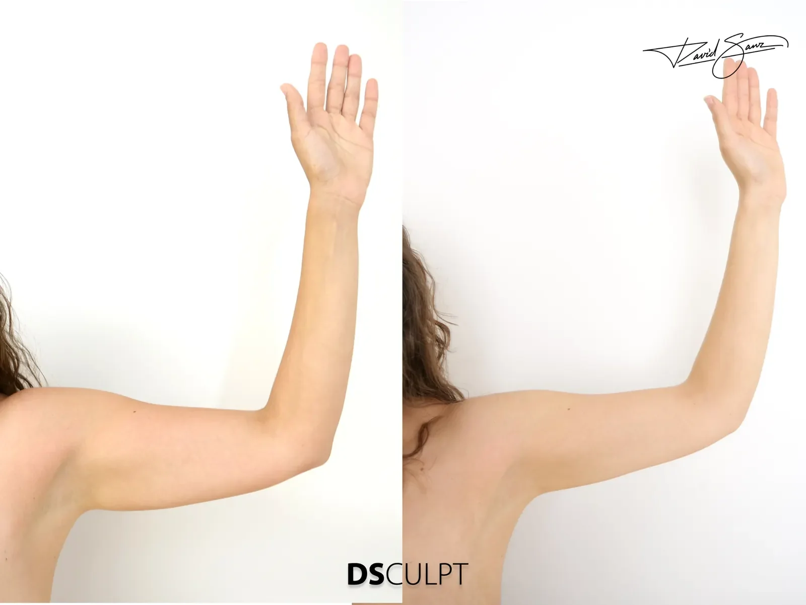 Antes y después de BodyTite en brazos para mejorar la flacidez posterior y definir el contorno del brazo.