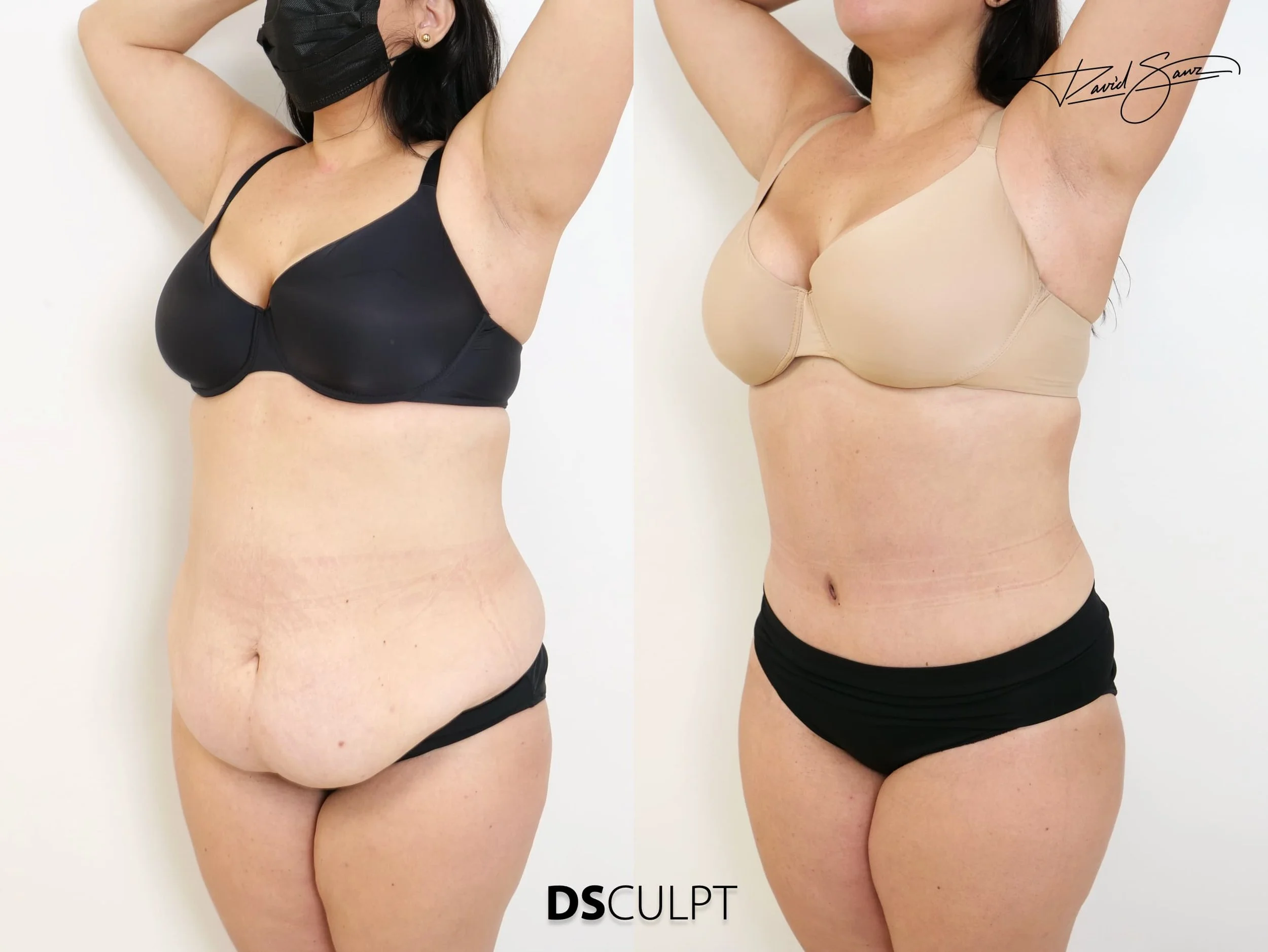 Antes y después de abdominoplastia para corregir faldón abdominal severo y exceso de piel