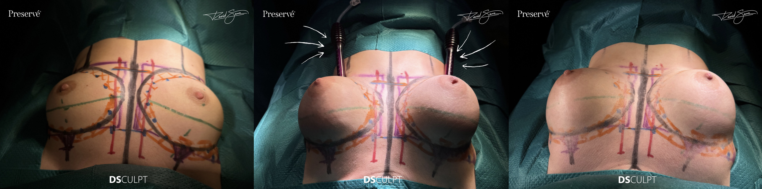 Marcaje preoperatorio para aumento mamario con técnica Preservé en Barcelona, planificación anatómica personalizada para lograr resultados naturales y proporcionales