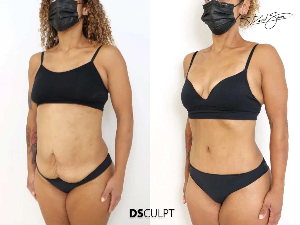 tensado de tejidos abdominales durante abdominoplastia en Barcelona