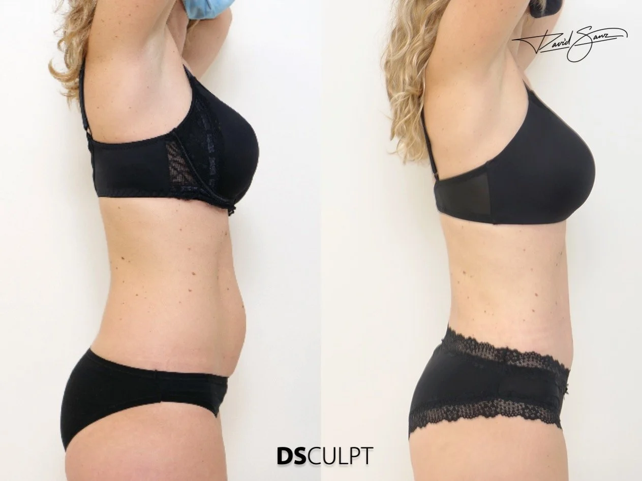 diástasis abdominal con debilidad del core y dolor lumbar asociado