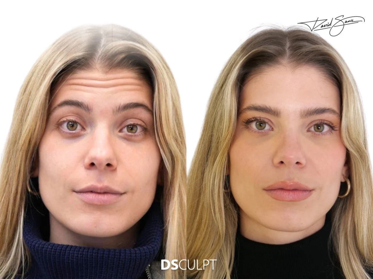 Precio del tratamiento con botox  toxina botulínica en Barcelona para frente y entrecejo