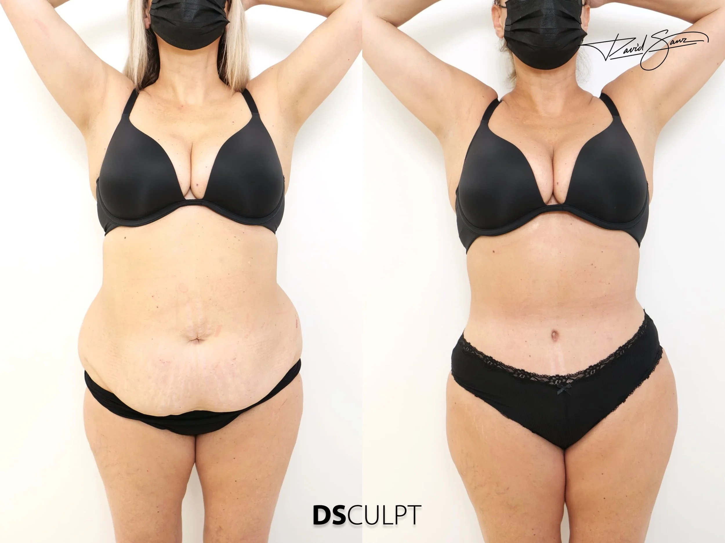 Abdominoplastia  para pacientes con gran faldón abdominal tras embarazos o pérdida masiva de peso. Eliminamos el exceso de piel y grasa y se corrige la distaseis