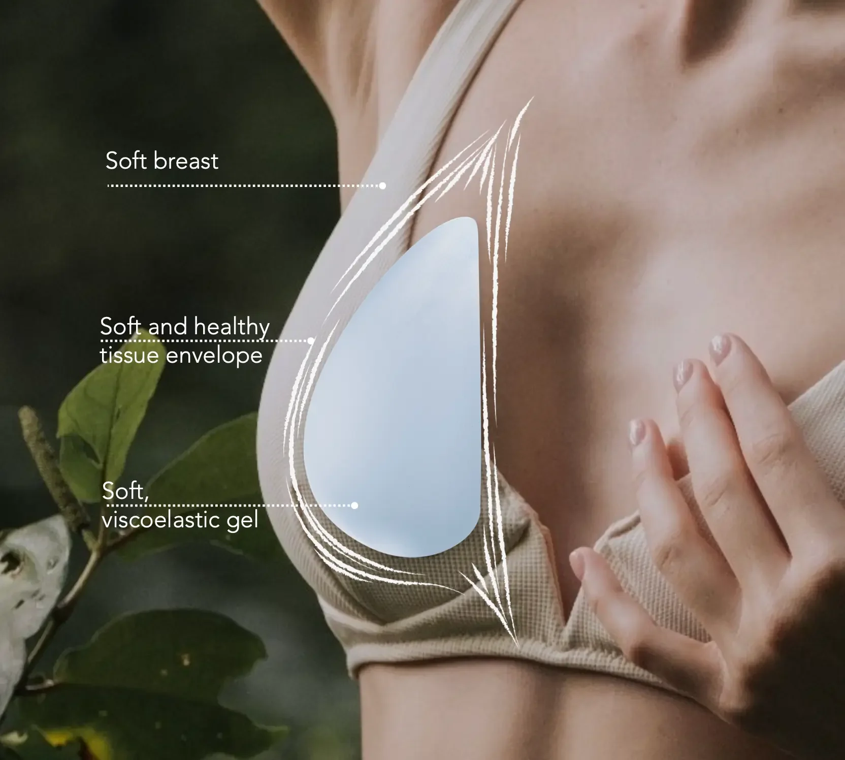 Implante Motiva Ergonomix2 colocado con técnica Preservé y rodeado por tejido mamario