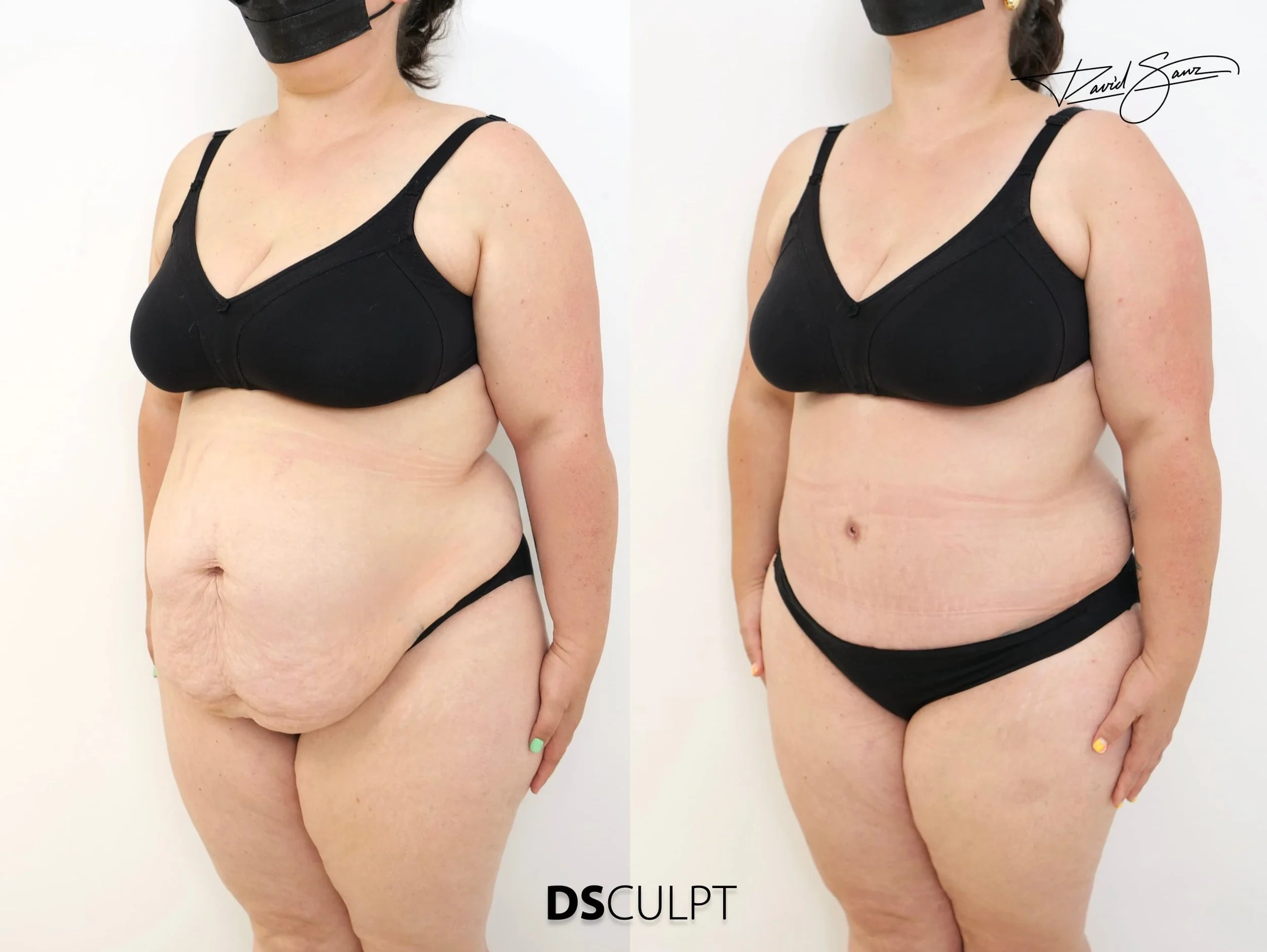 Comparativa antes–después en paciente con barriga colgante corregida mediante abdominoplastia