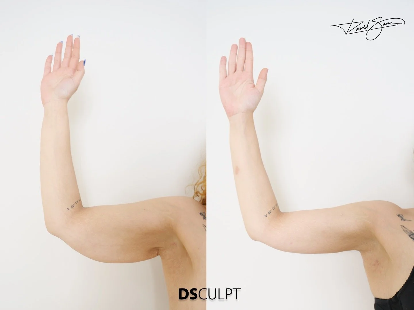 Precio cruroplastia en Barcelona en DSculpt Clinic