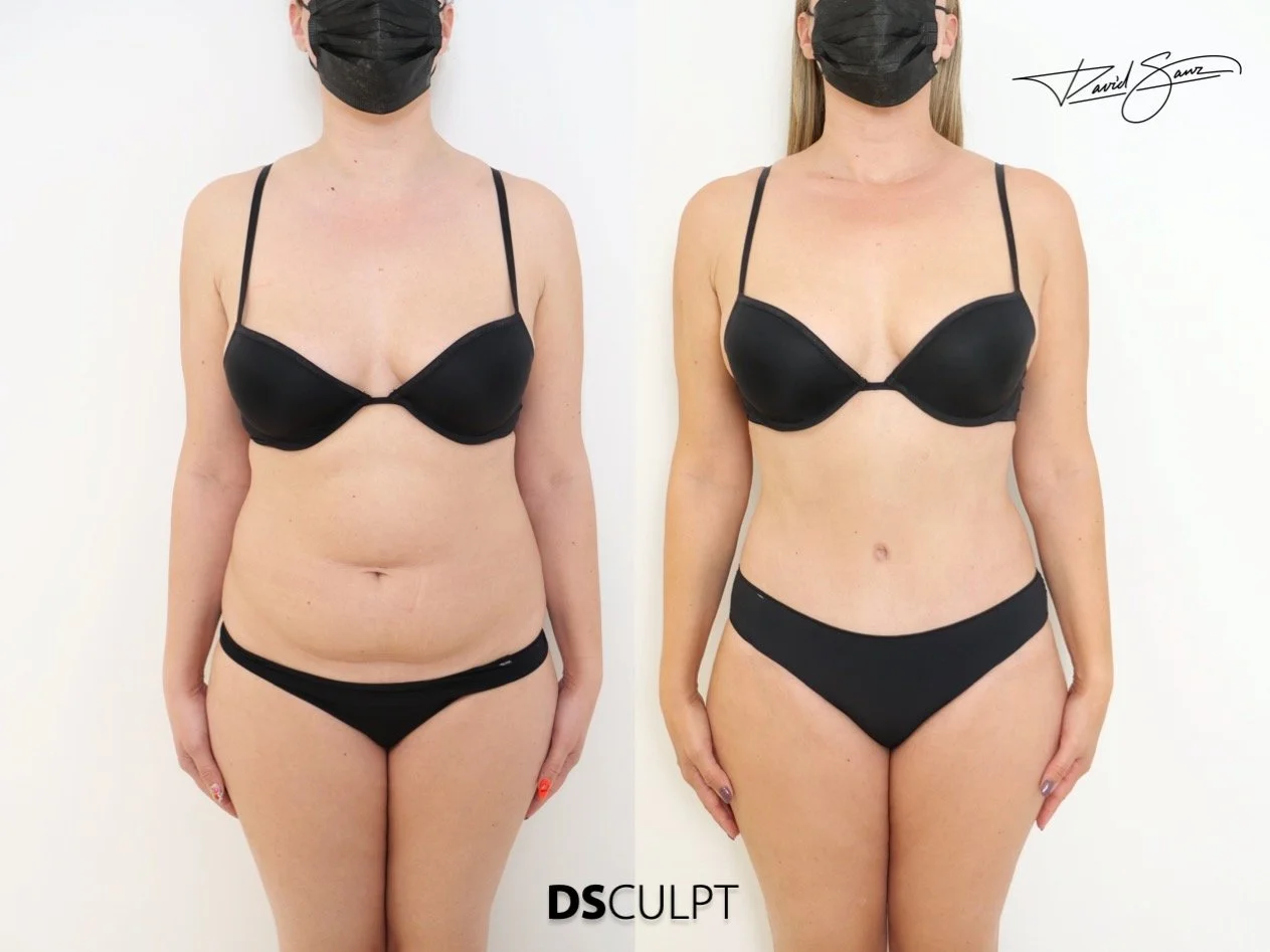 esultado de abdominoplastia en Barcelona con abdomen plano y natural tras cirugía