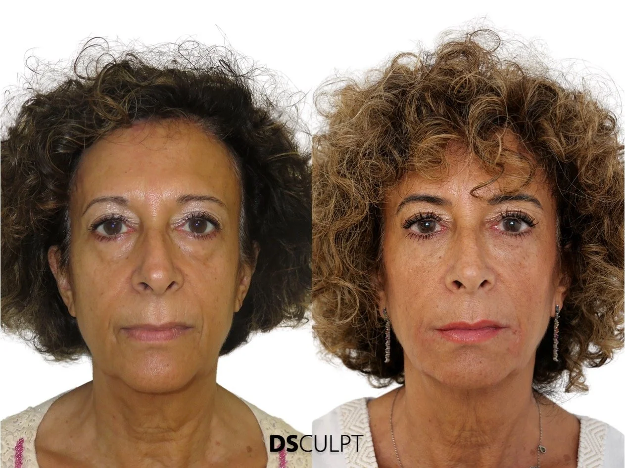 Morpheus facial para mejorar flacidez leve o moderada