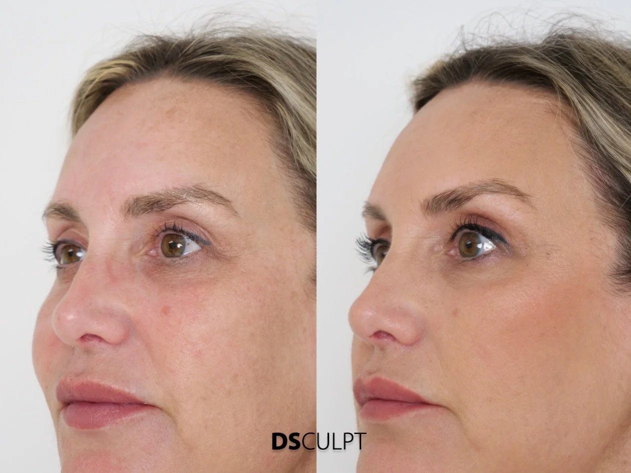 Tratamiento Smart DNA en Barcelona para regeneración cutánea y rejuvenecimiento facial natural