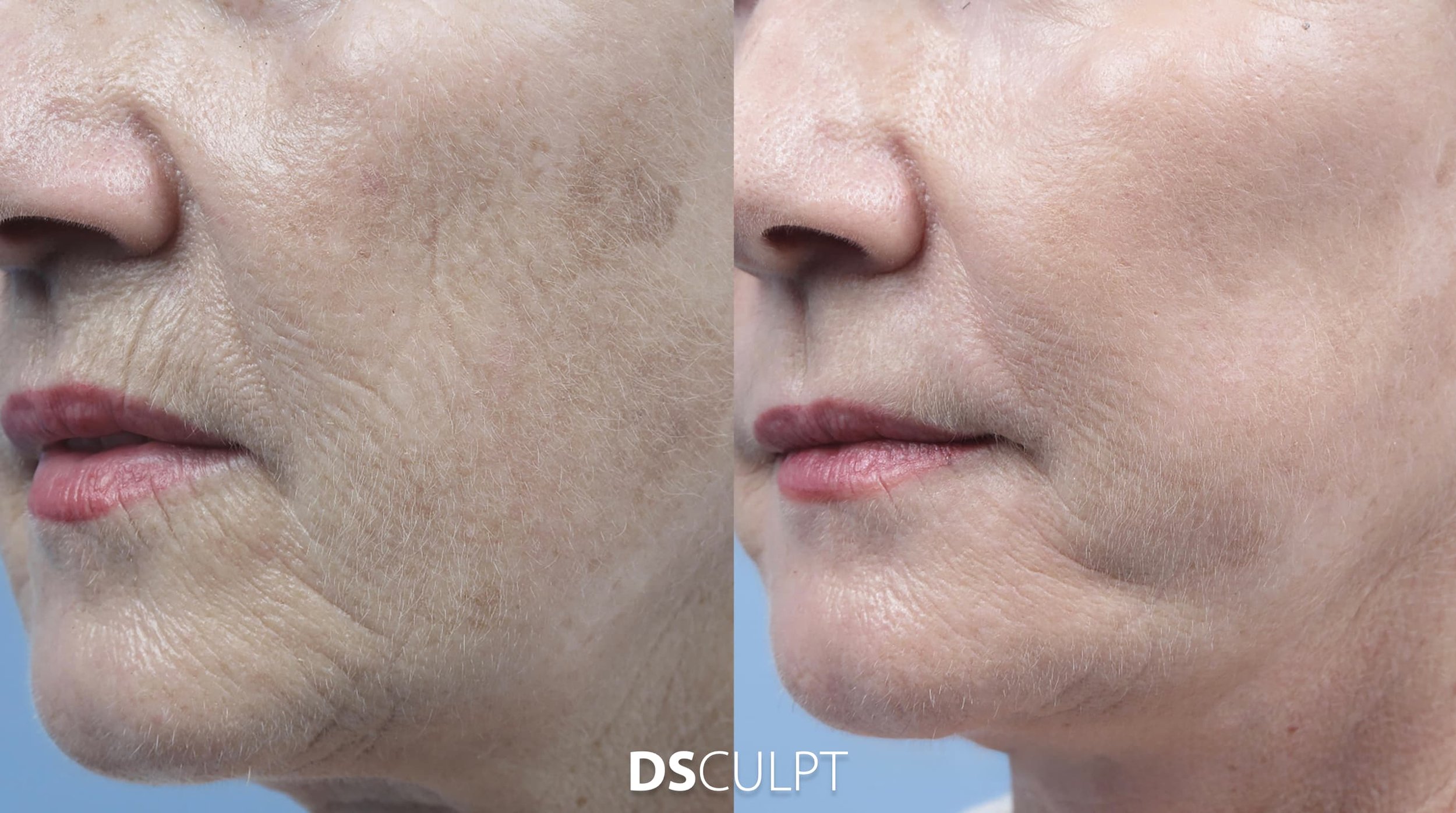 Antes y después de Morpheus facial en Barcelona para mejorar arrugas finas, textura y calidad de la piel del rostro