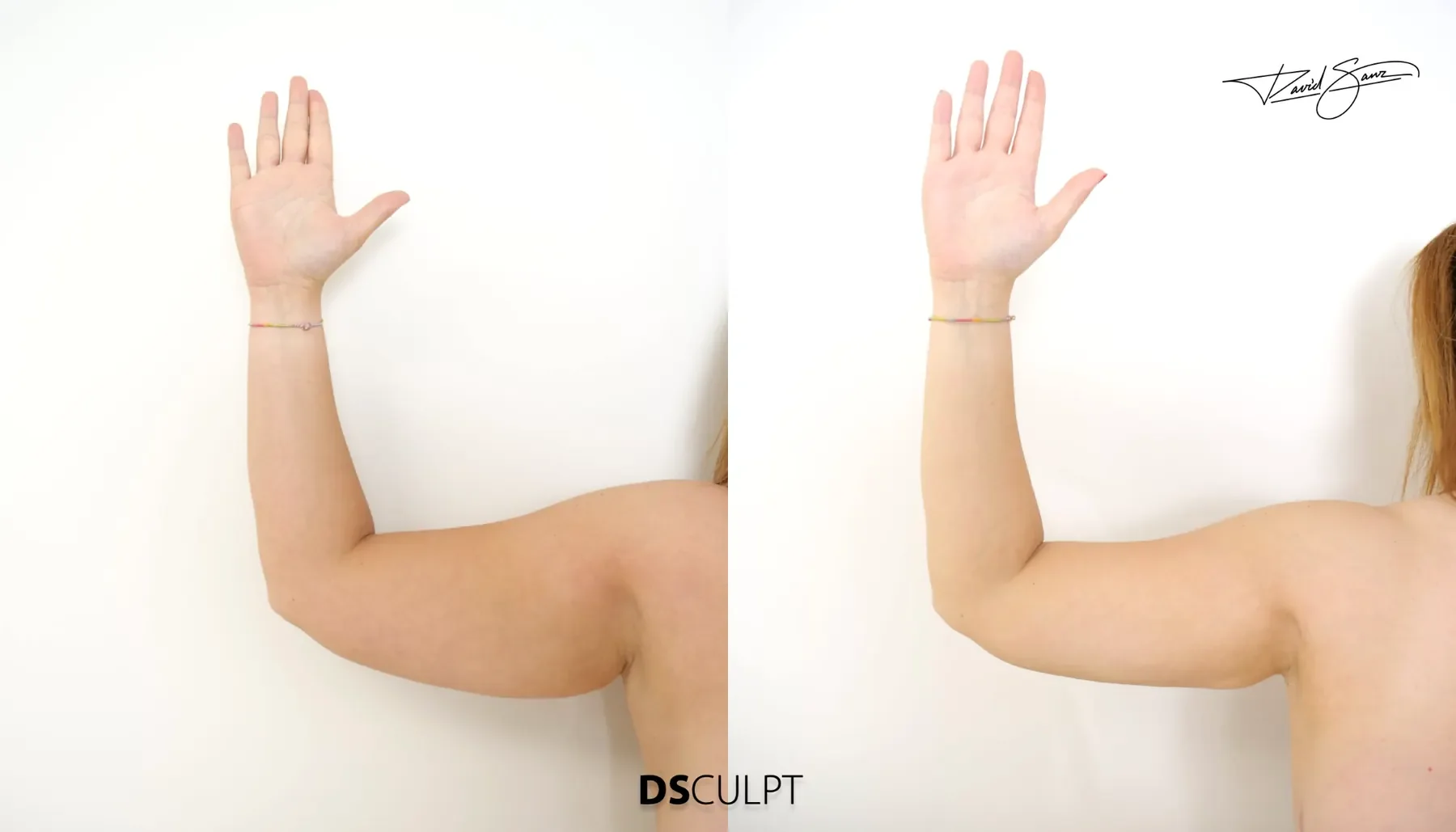 Resultado clínico antes y después de BodyTite para mejorar el contorno de los brazos