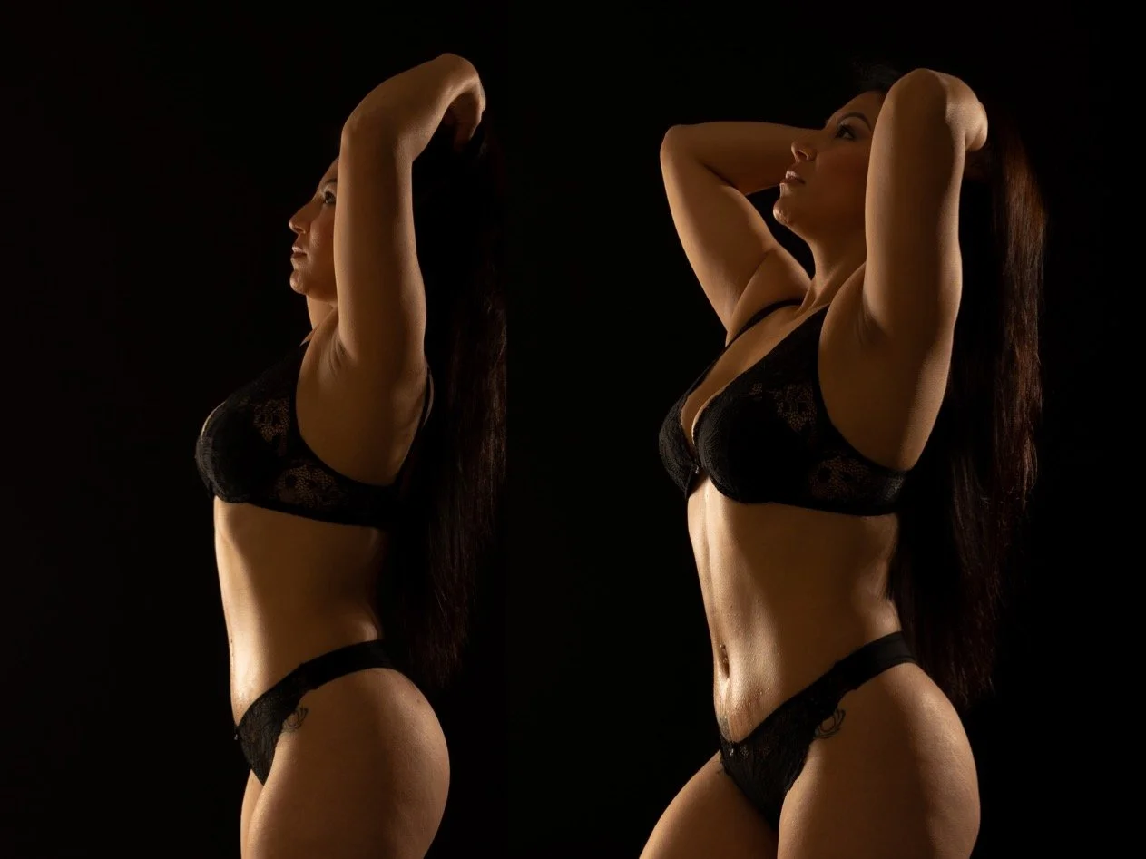 remodelación abdominal completa mediante cirugía en Barcelona