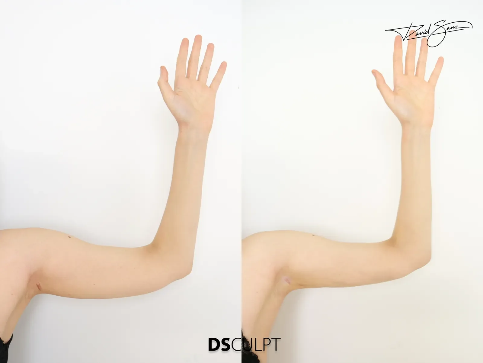 Antes y después de BodyTite con mejora de la definición y del contorno del brazo en paciente real.