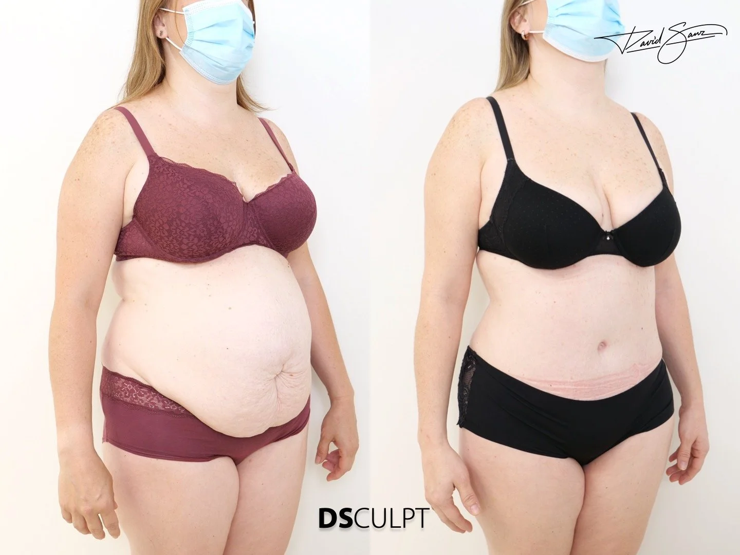 Resultado de abdominoplastia compleja con reconstrucción abdominal en Barcelona