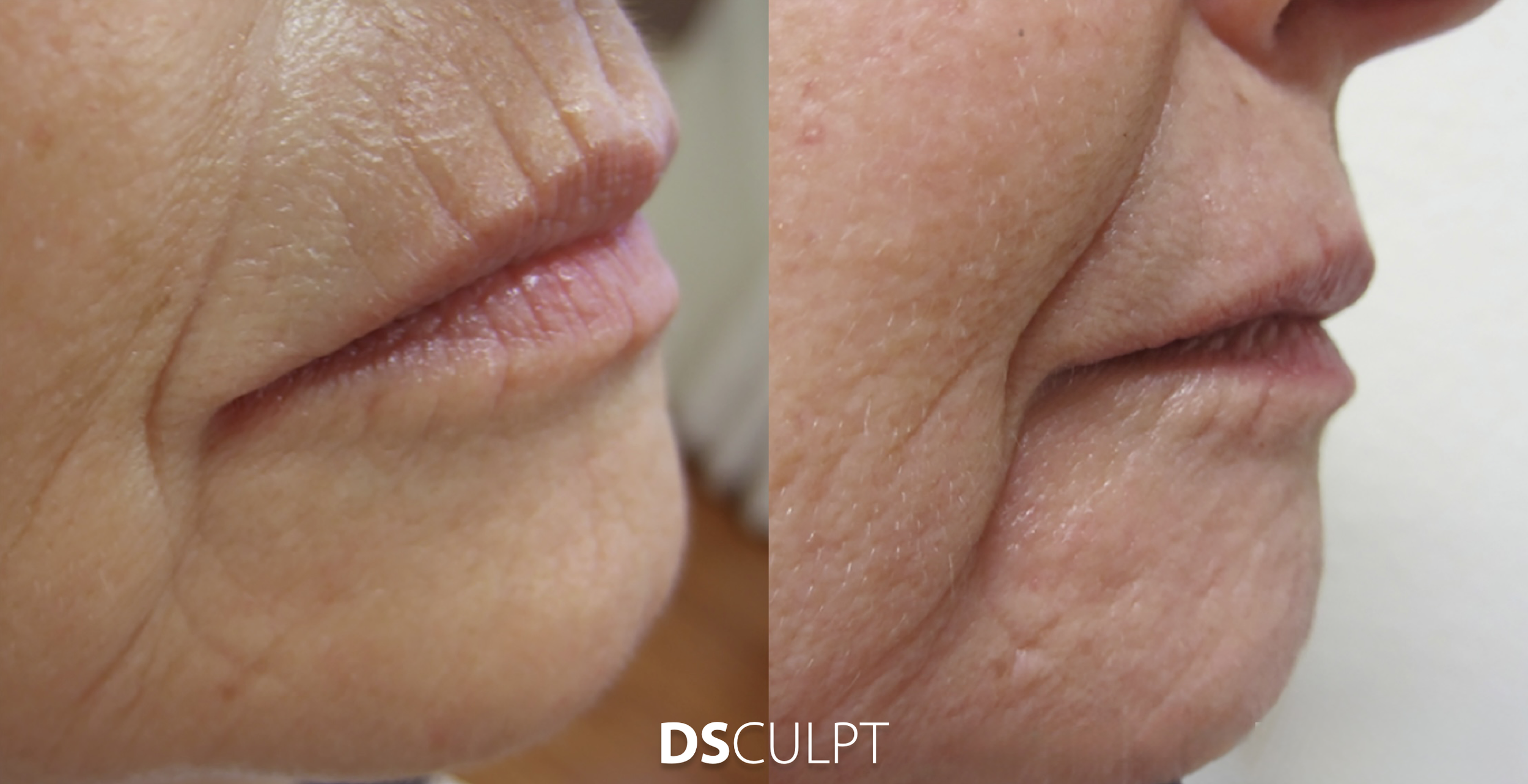 Antes y después de Morpheus para código de barras en Barcelona, mejorando arrugas finas del labio superior sin cirugía