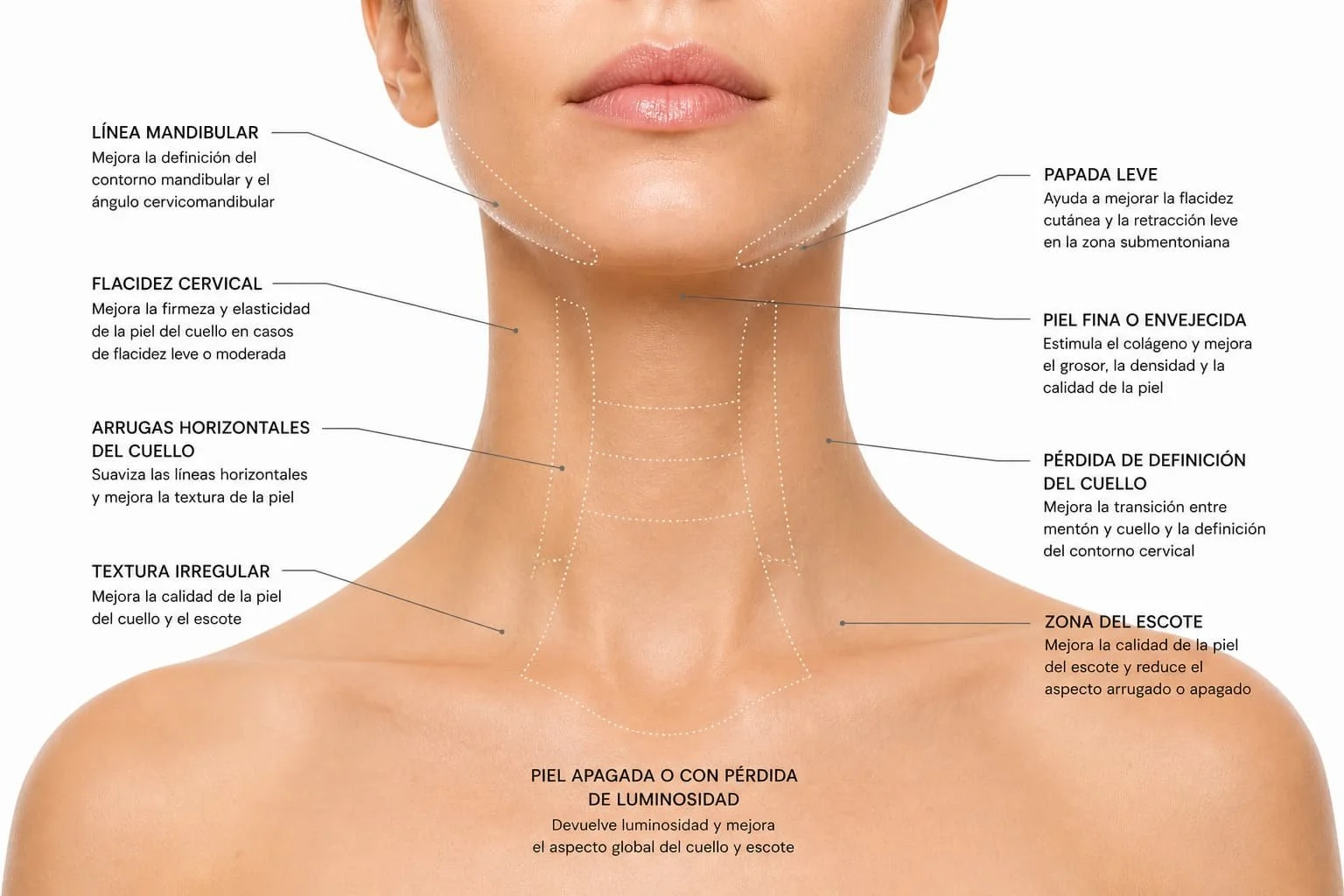 Indicaciones de Morpheus para flacidez cervical papada y línea mandibular
