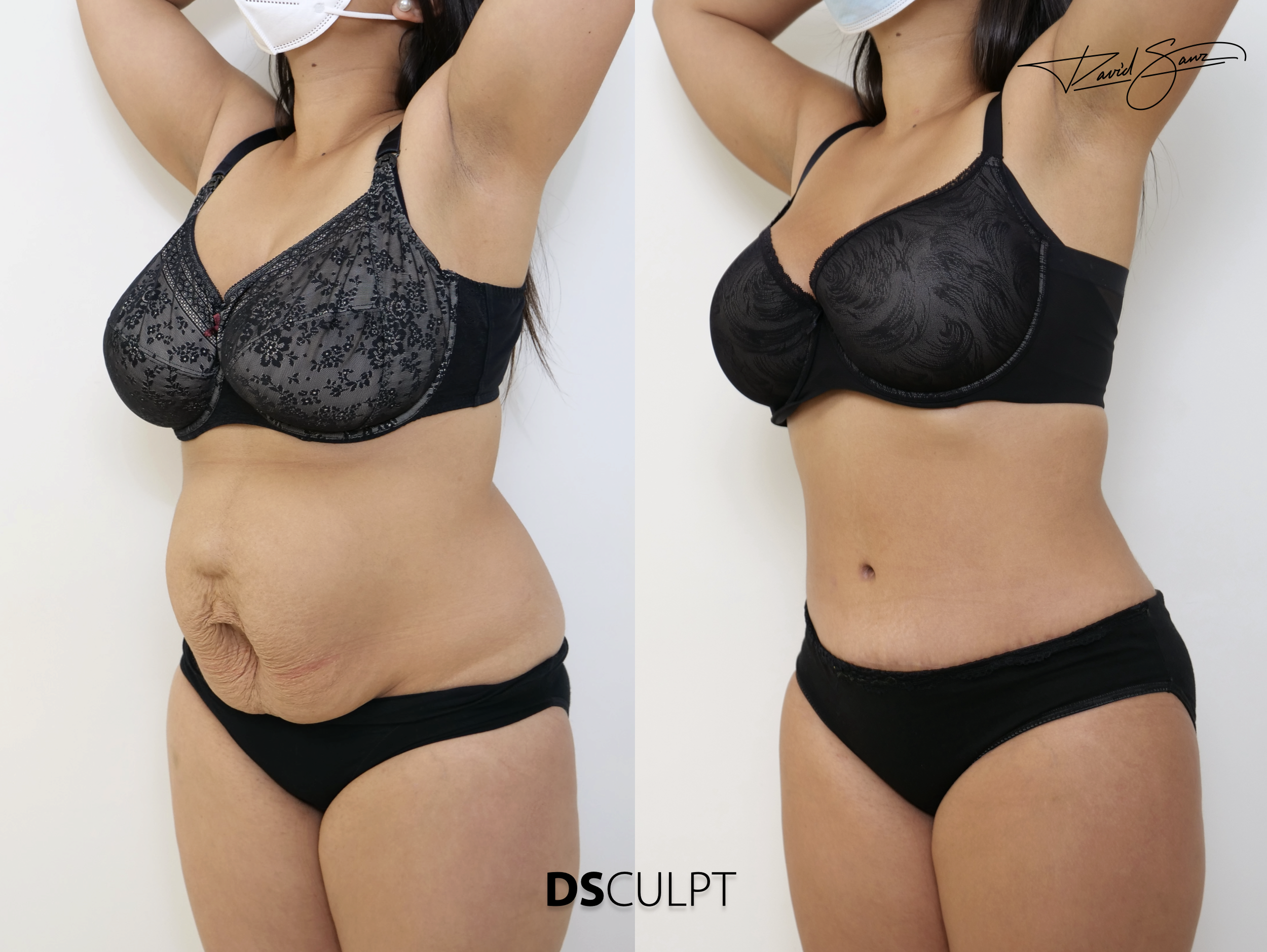 reparación muscular del abdomen durante cirugía de diástasis en Barcelona