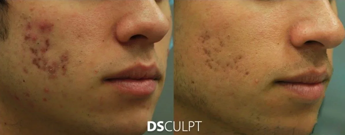Morpheus combinado con peelings subcisión y bioestimulación