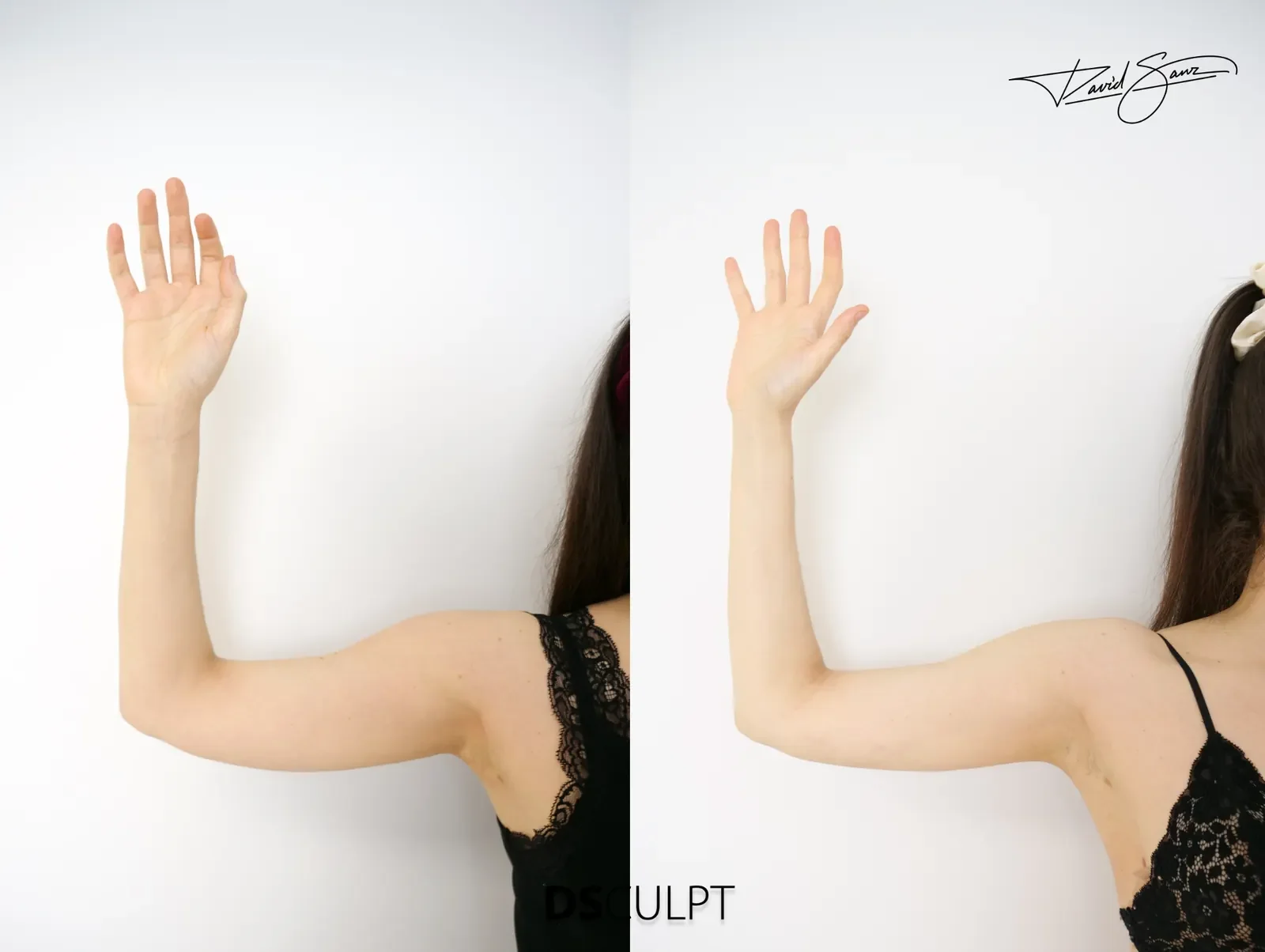 Remodelación de brazos con BodyTite en paciente con piel laxa y pérdida de definición del contorno.