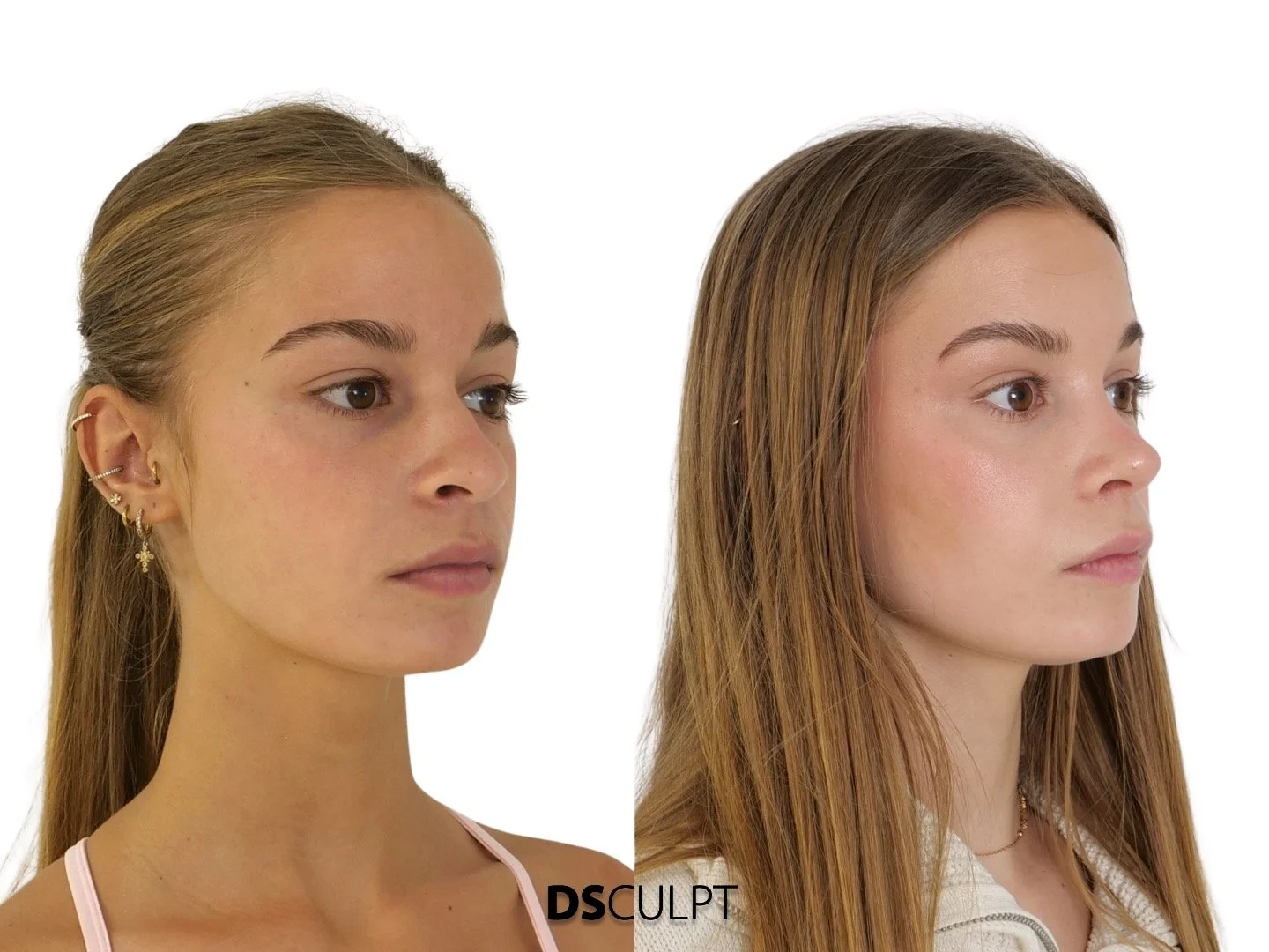 Mejor clínica para hacerse una rinoplastia en Barcelona