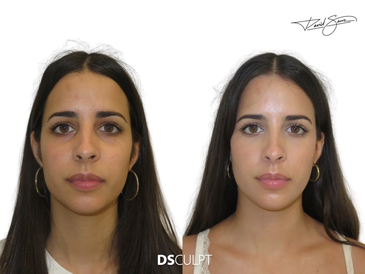 Precio del tratamiento de ojeras con ácido hialurónico en Barcelona en clínica médica