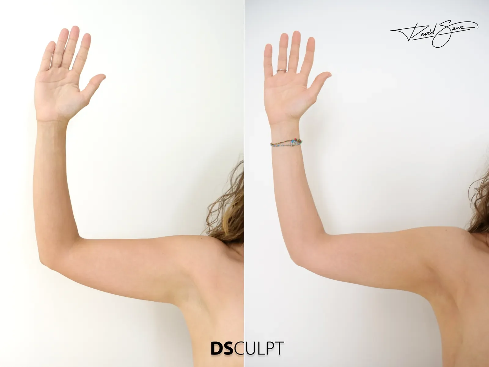 Antes y después de radiofrecuencia bipolar BodyTite para mejorar el contorno y la retracción cutánea de los brazos