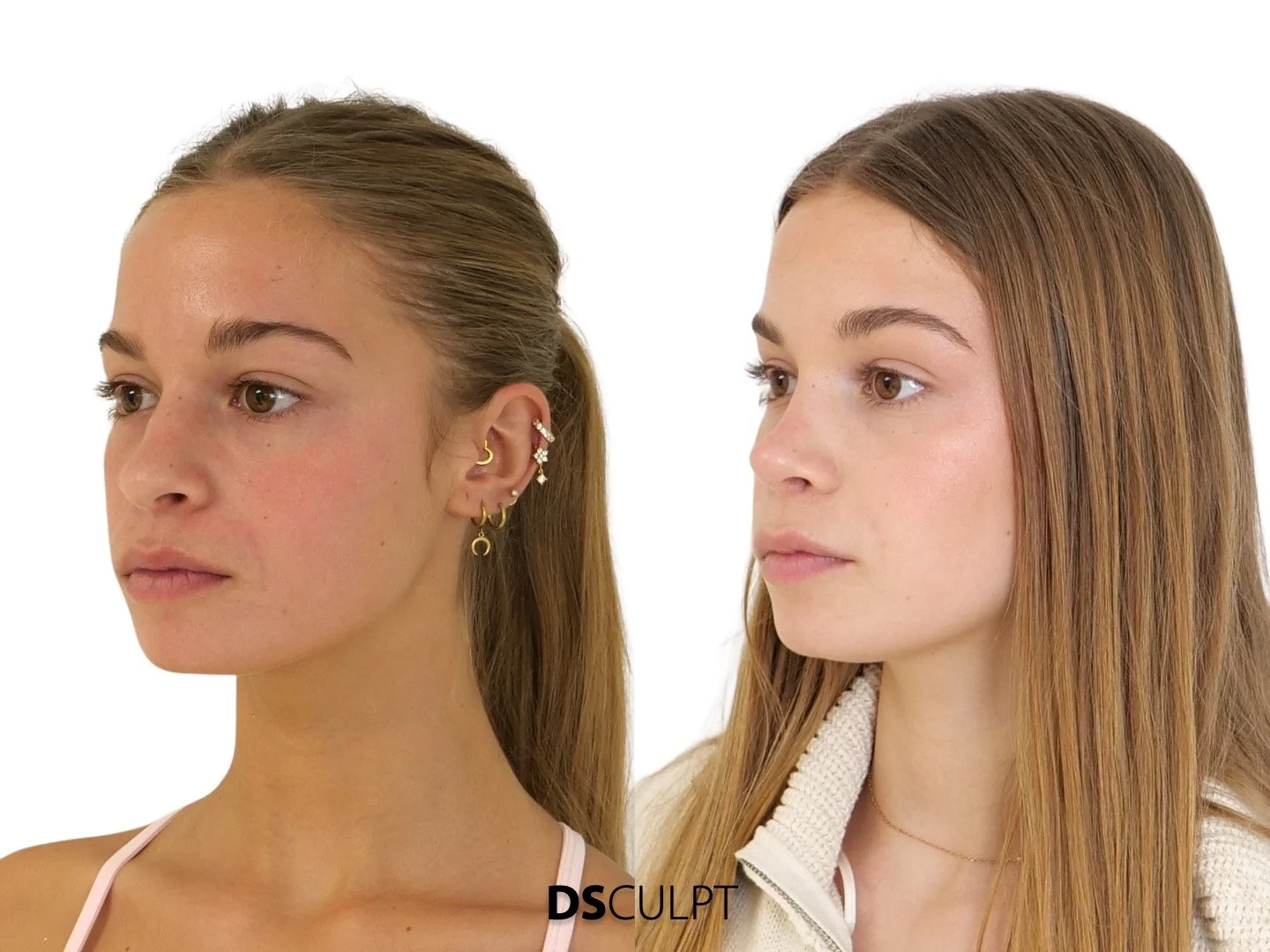 Precio rinoplastia ultrasónica en Barcelona en DSculpt Clinic