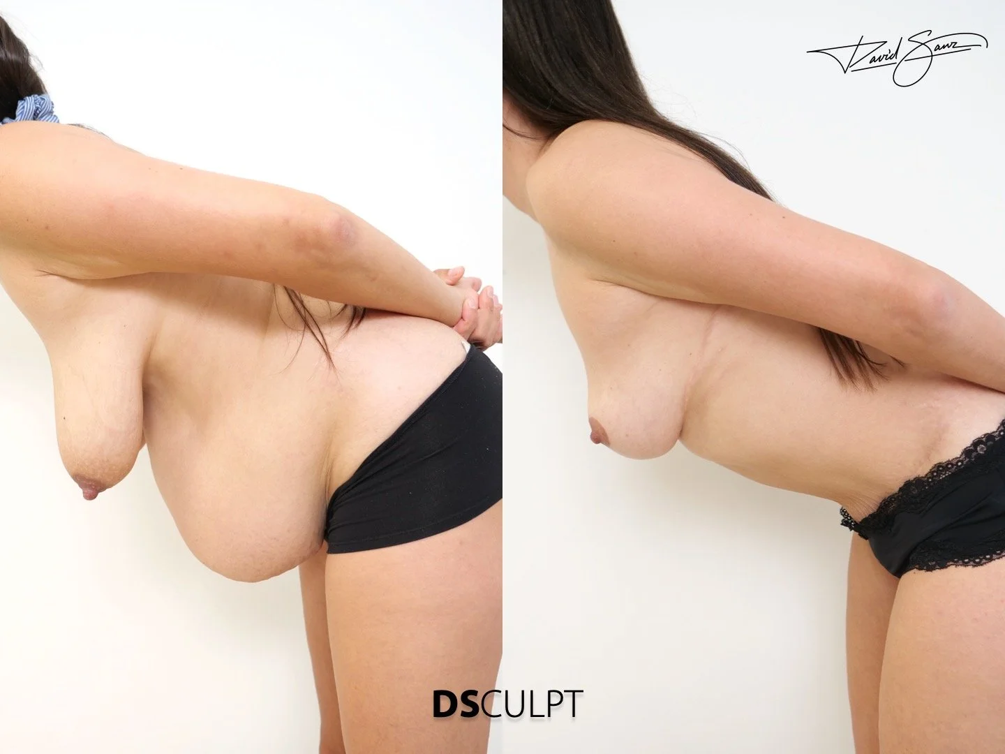 Resultado de cirugía estética abdominal Total Body Mommy Makeover en Barcelona