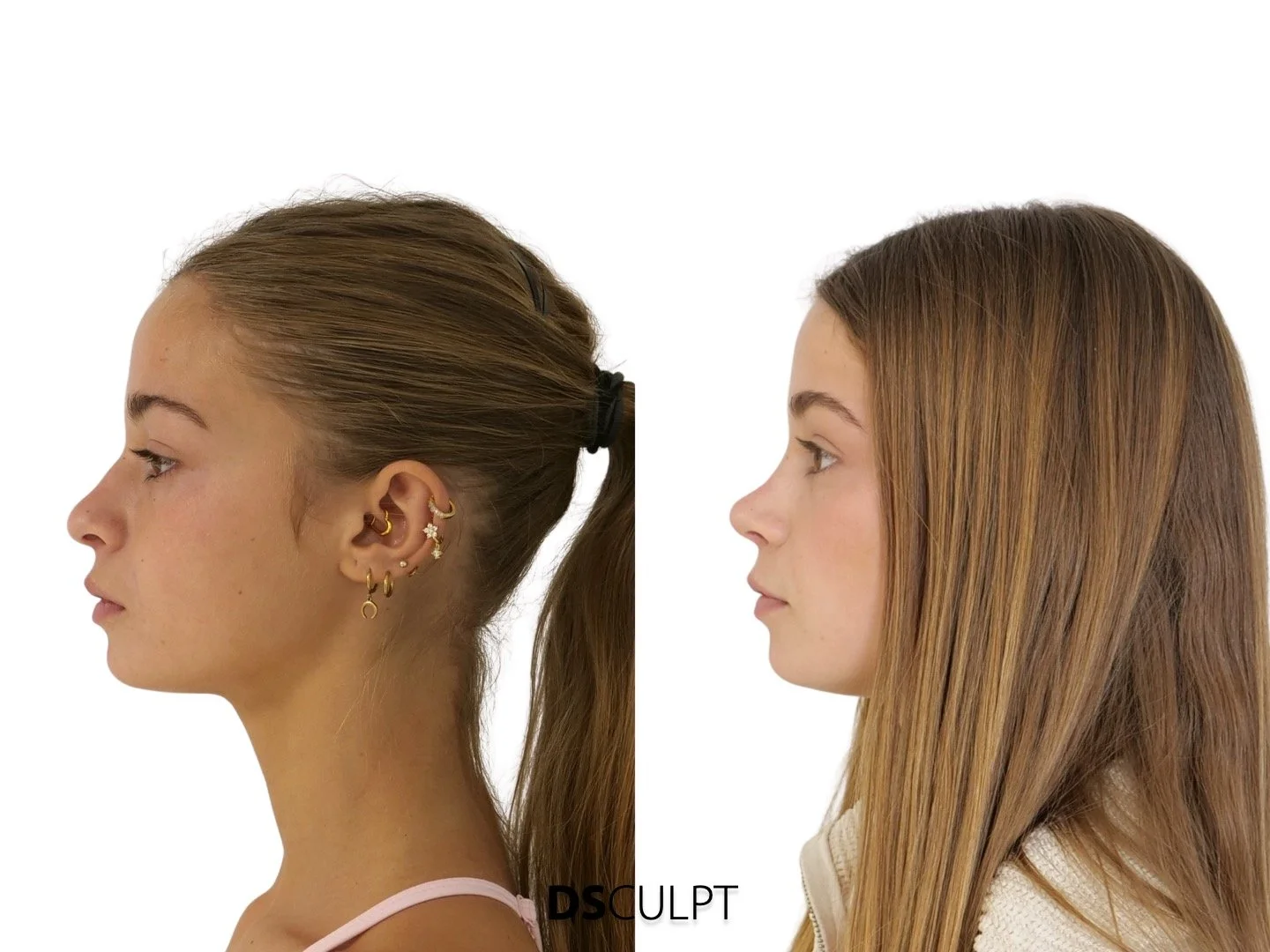 Resultado de rinoplastia ultrasónica en Barcelona con técnica avanzada de precisión