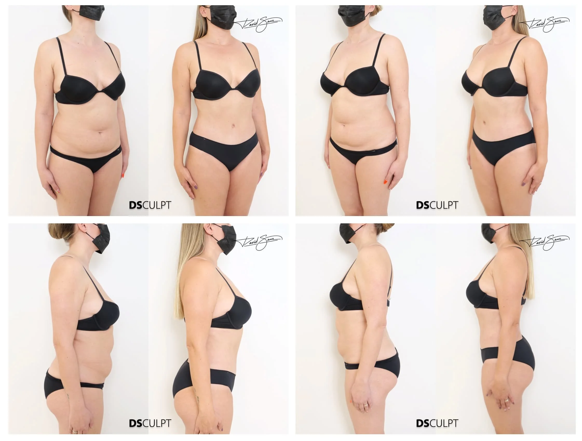 antes y después de cirugía abdominal en Barcelona con eliminación de flacidez