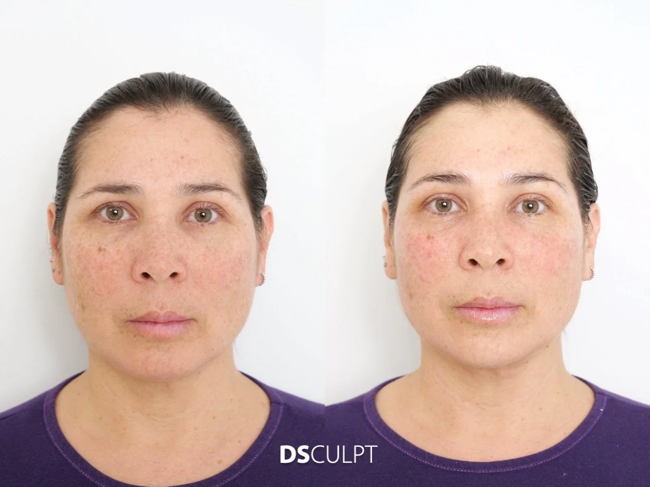 Comparativa antes y después del tratamiento Smart DNA facial en Barcelona para mejorar luminosidad y uniformidad cutánea