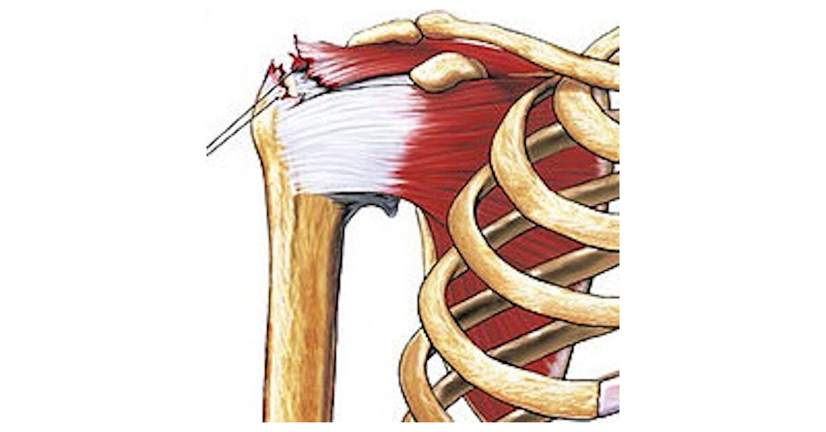 Rotator Cuff Tears - How physio can help! - First Line Physio