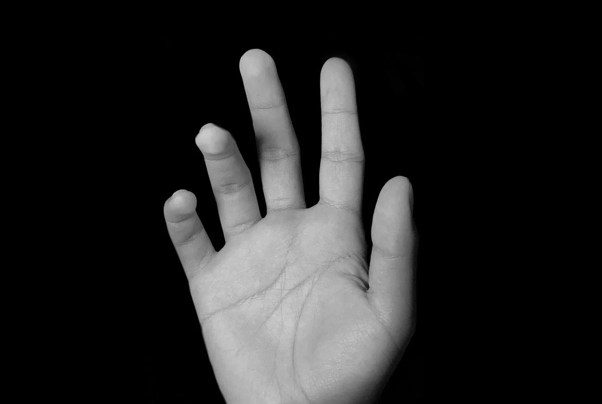 Complex Regional Pain Syndrome (CRPS) of the hand