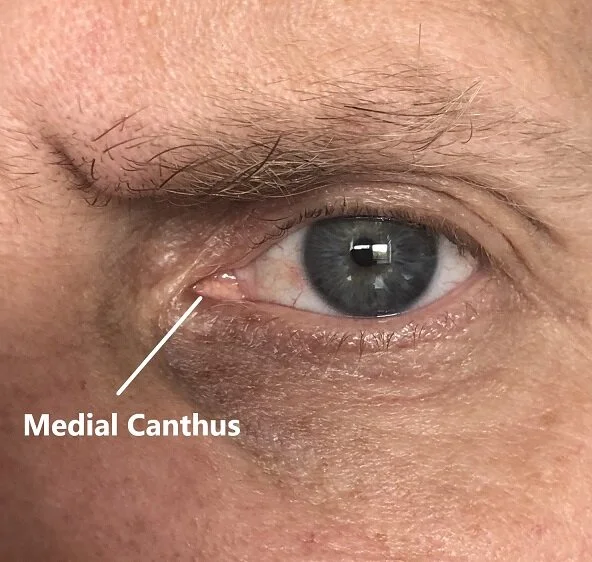 medial canthus_lres.jpg