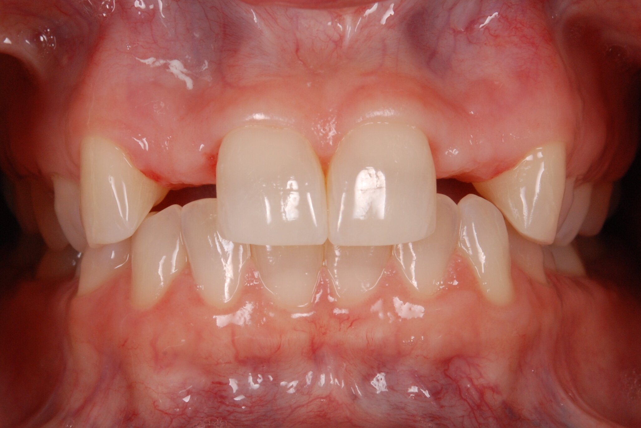 Before: Patient prior to being restored with bilateral cantilever bridges 