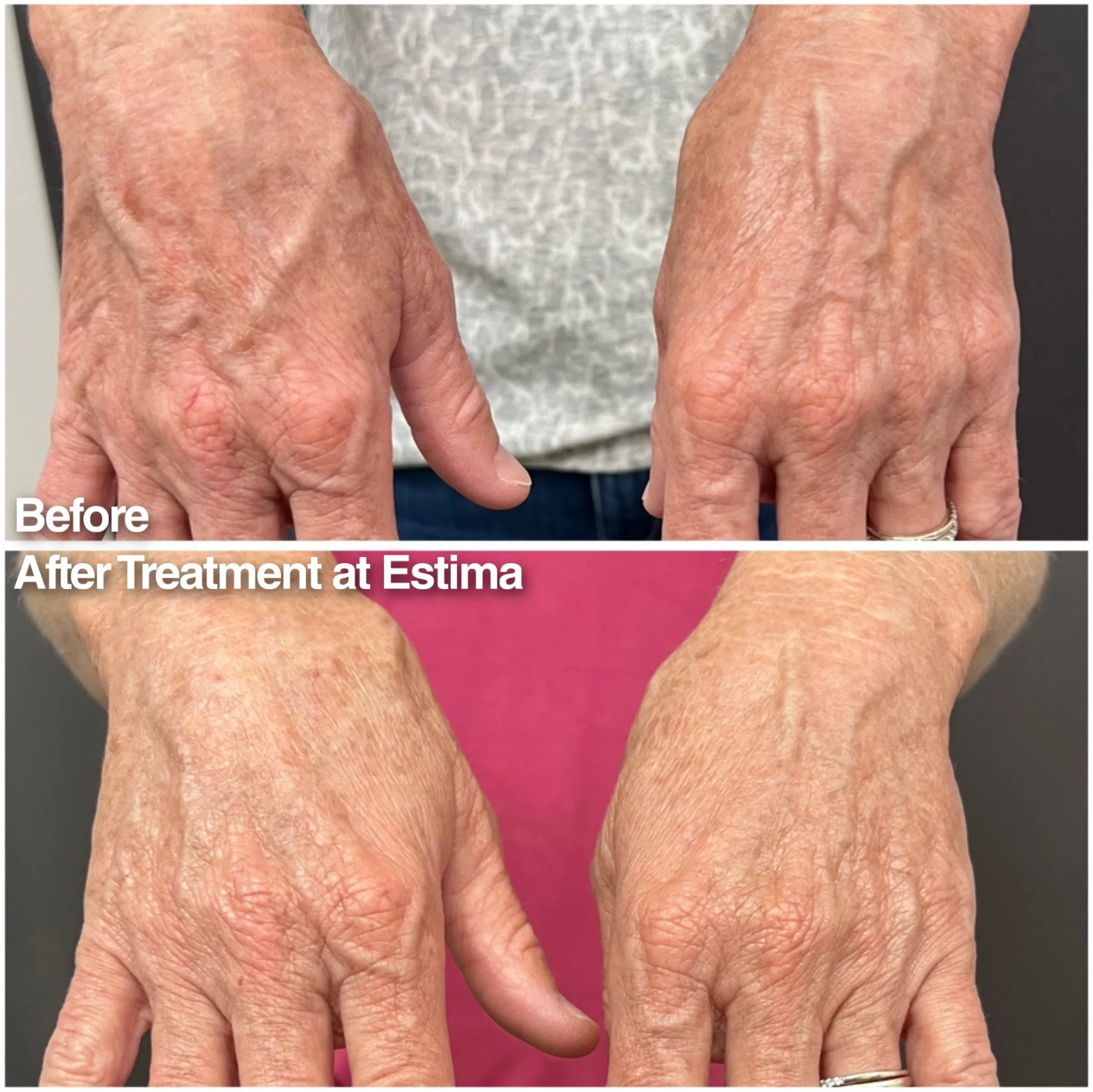 Before and after hand filler at Estima to help give back the volume lost to aging