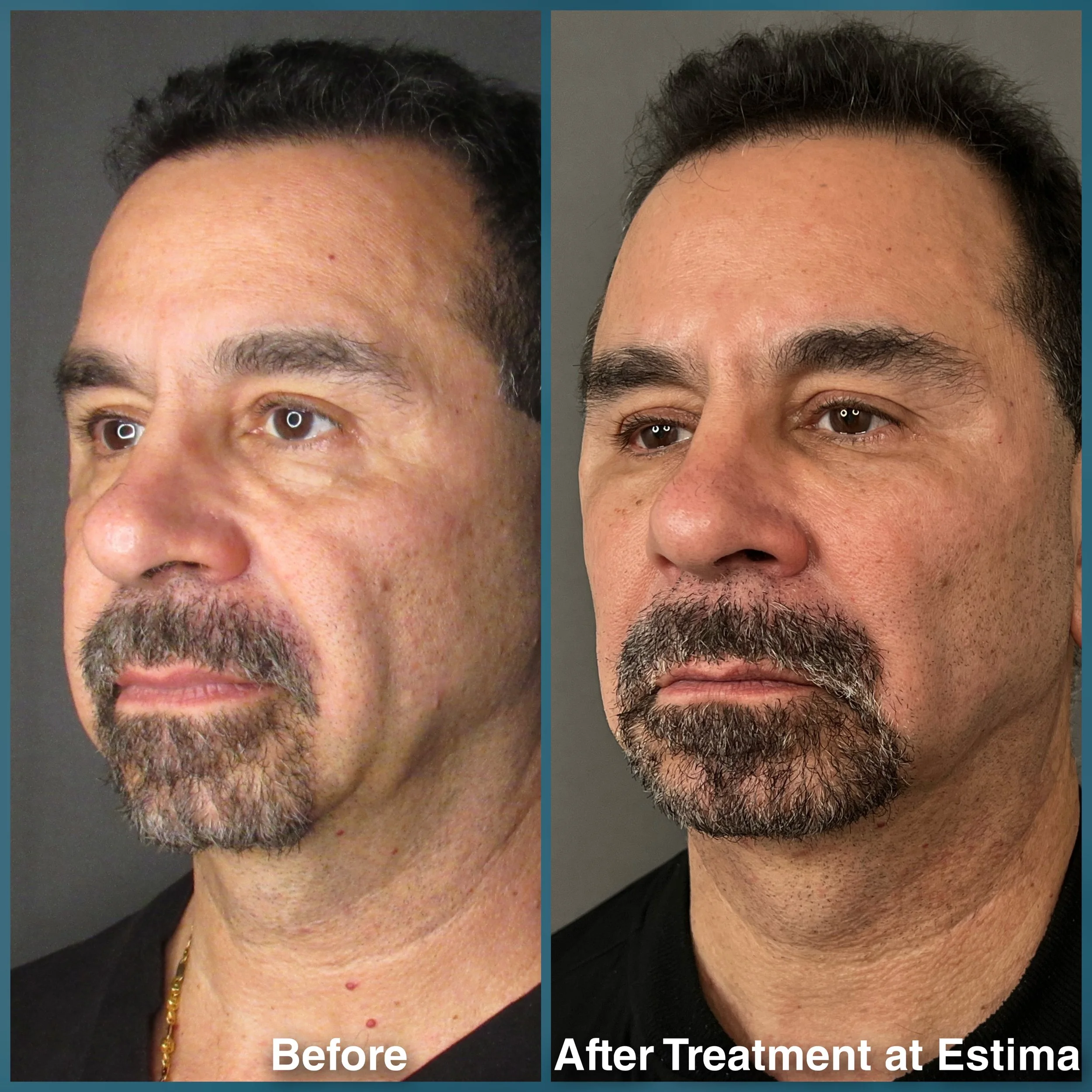 Before & After full assessment and treatment as Estima including a variety of treatments specific to the individual's goals