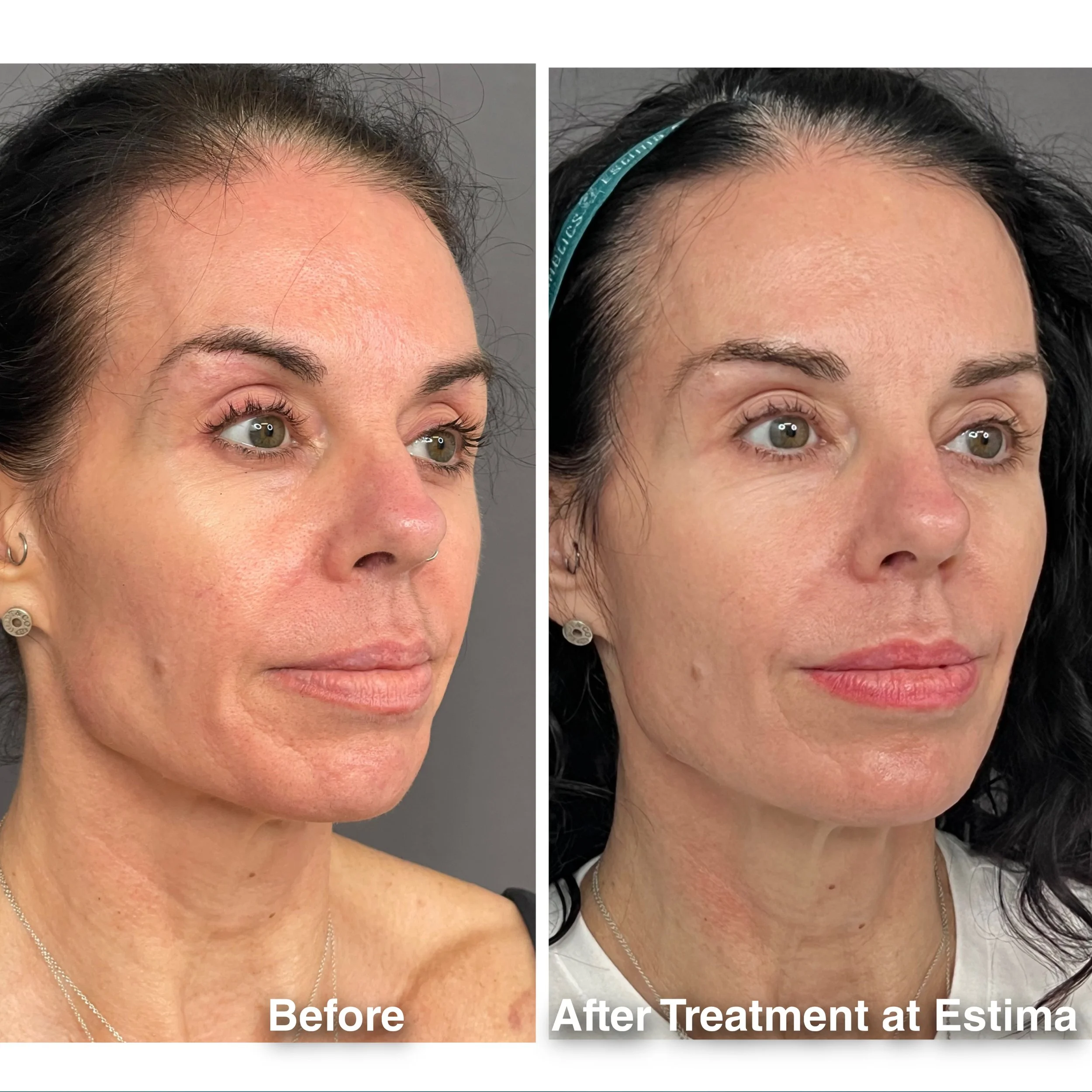 Before & After full assessment and treatment as Estima including a variety of treatments specific to the individual's goals