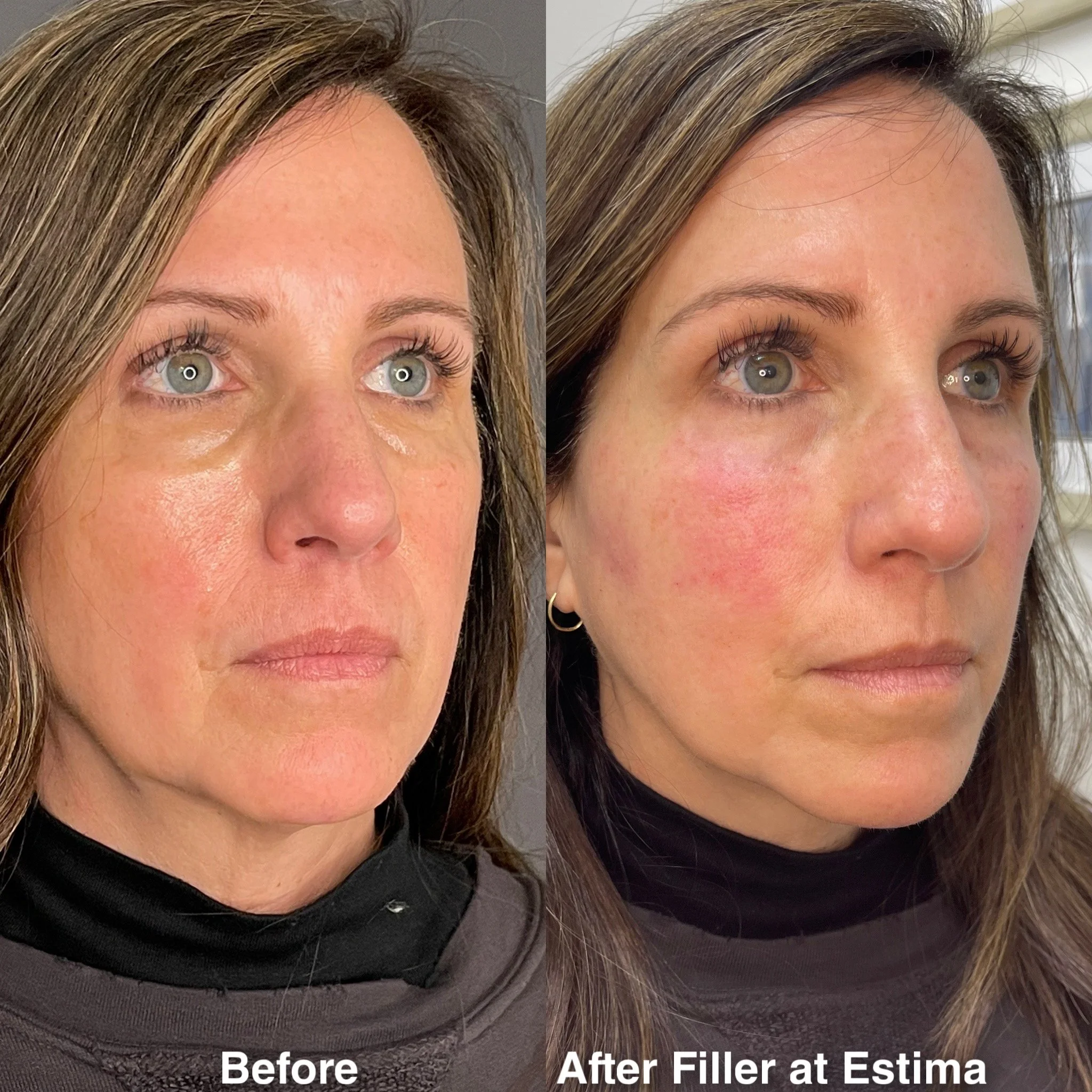 Before & After full assessment and treatment as Estima including a variety of treatments specific to the individual's goals