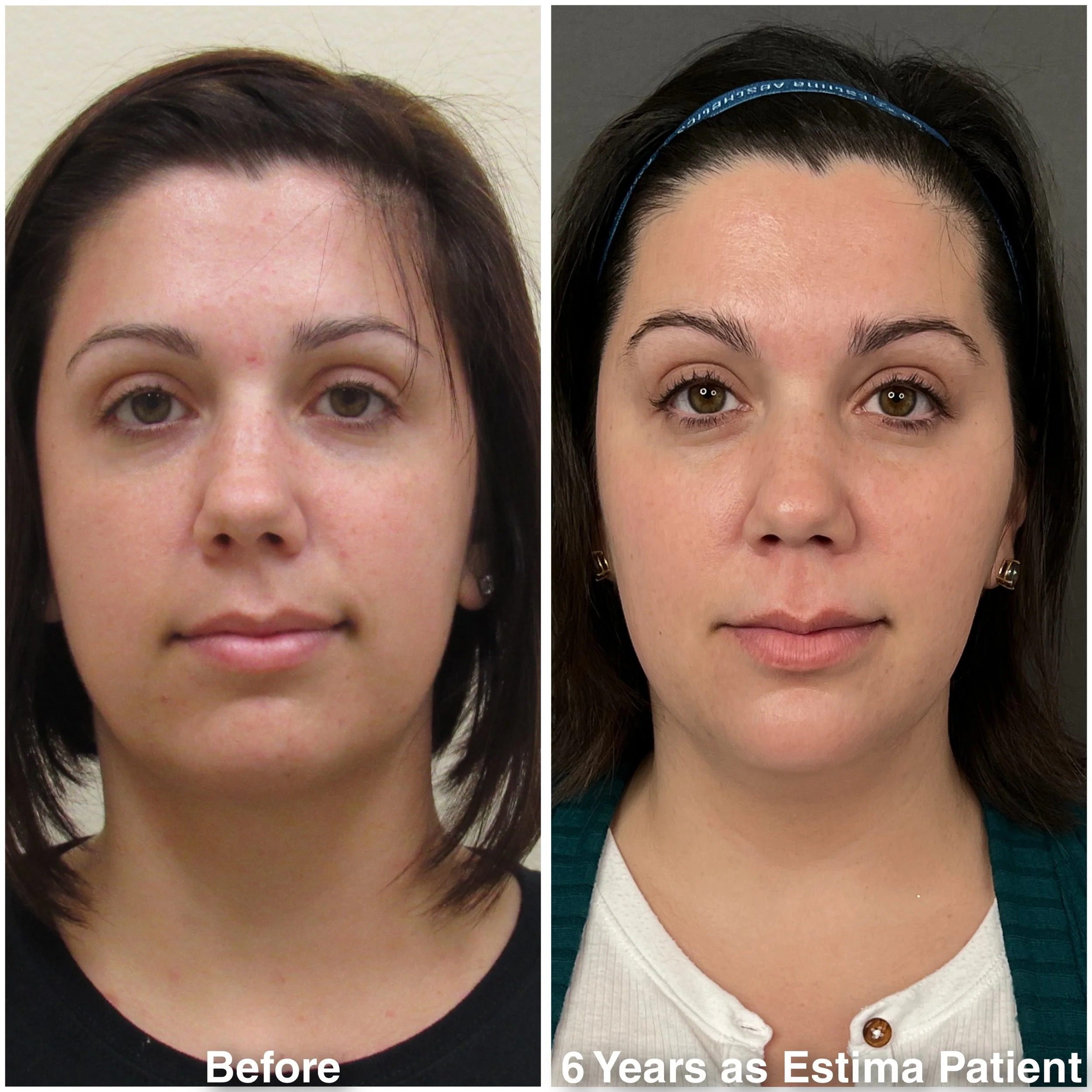 Before & After full assessment and treatment as Estima including a variety of treatments specific to the individual's goals