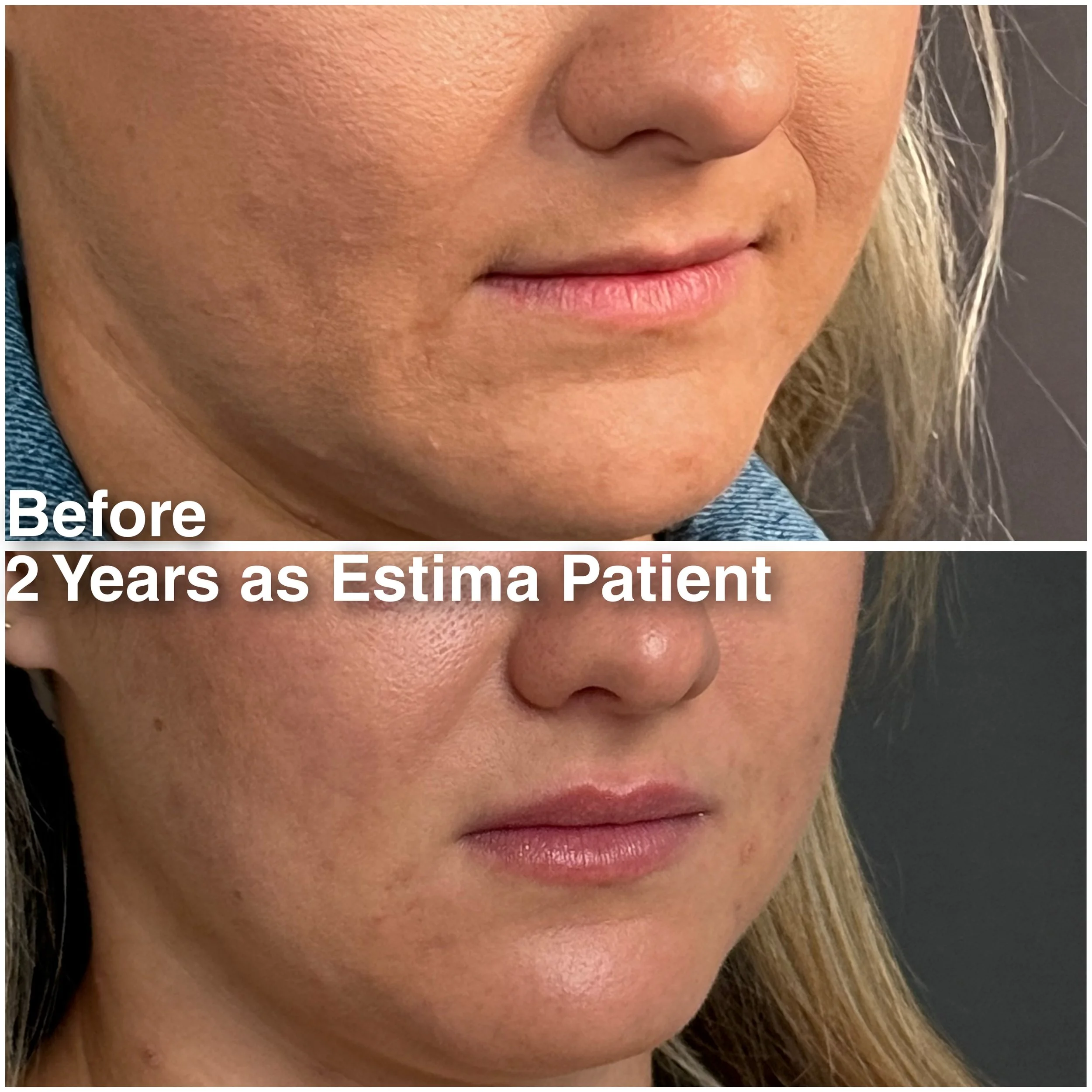 Before & After full assessment and treatment as Estima including a variety of treatments specific to the individual's goals
