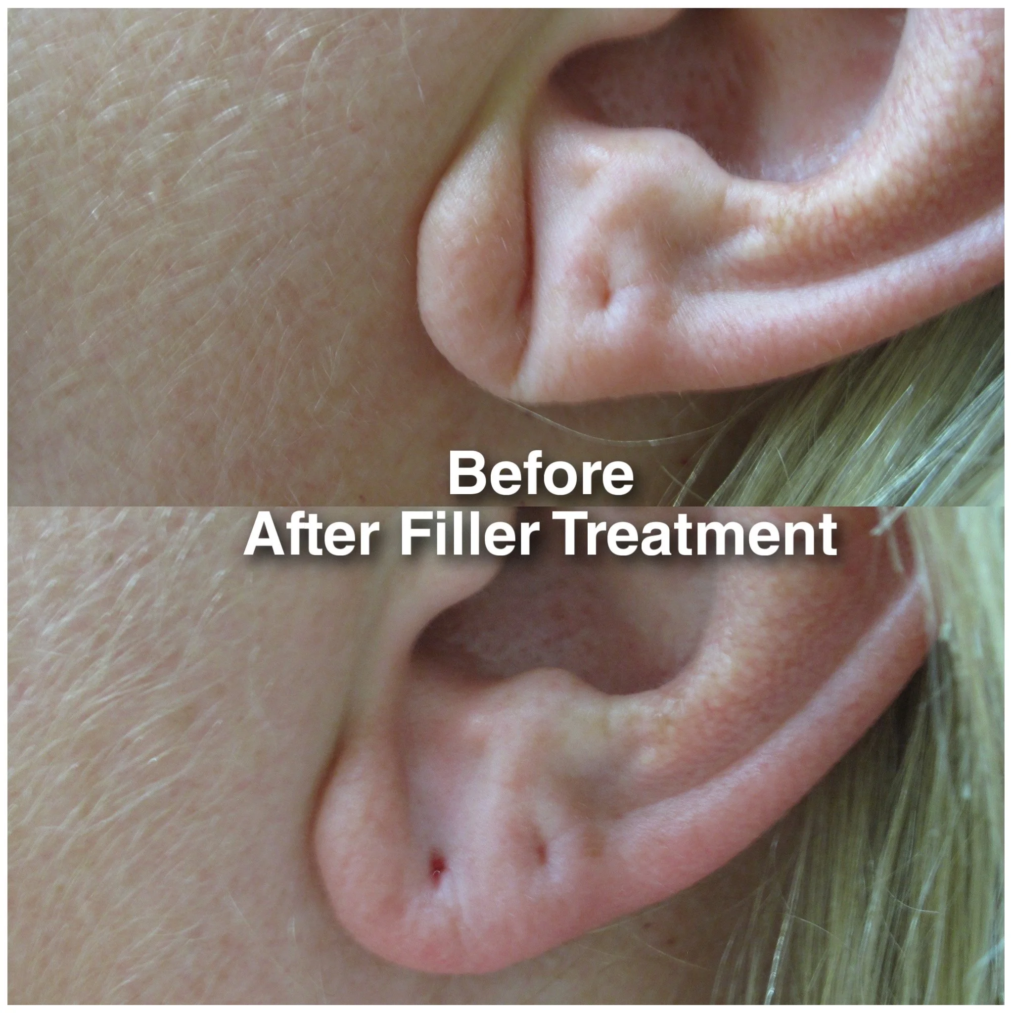 Before and after filler treatment to help correct line in earlobe and provide additional support